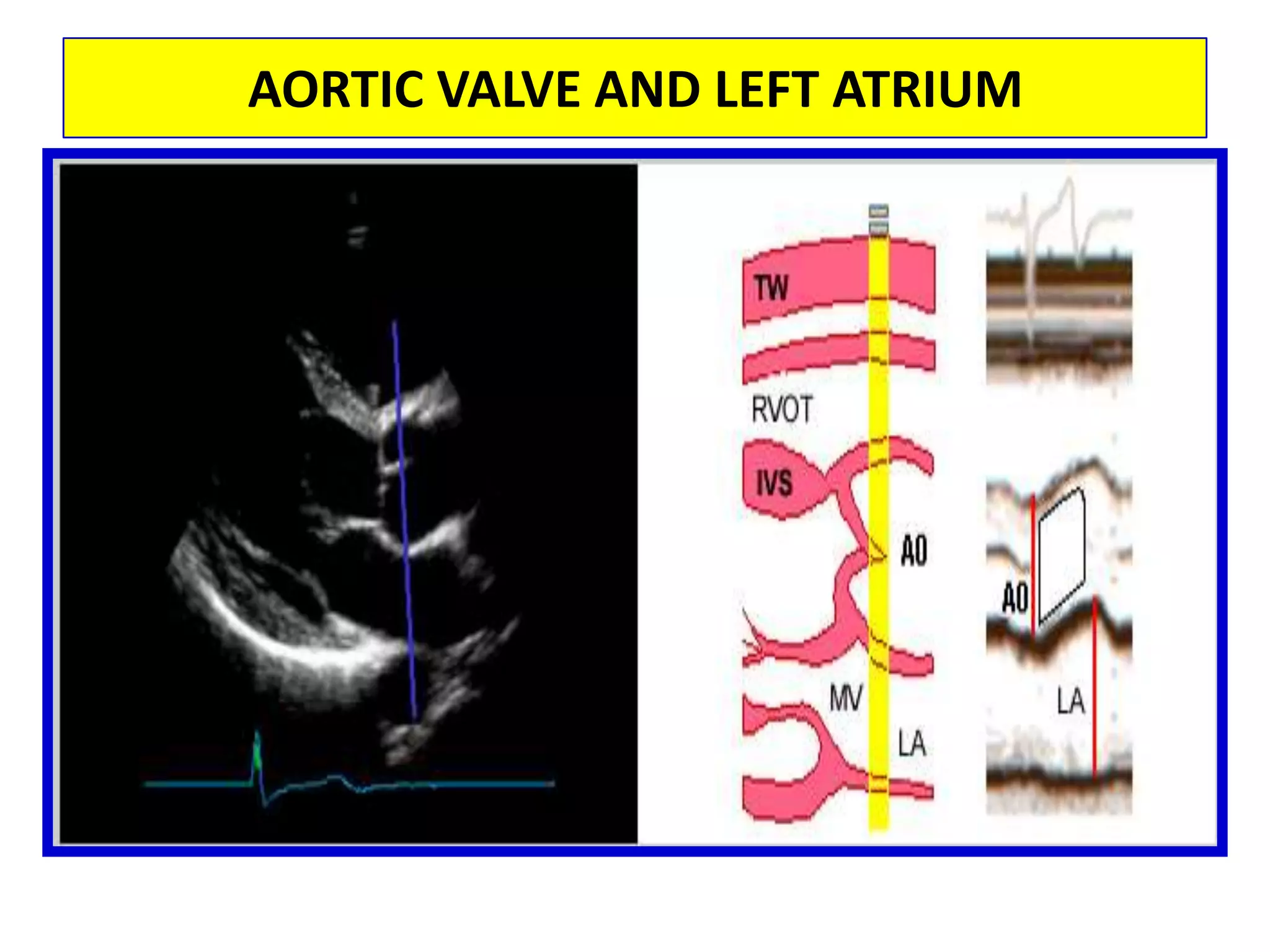 Apical Window2-Chamber ViewSweeping begins at the anterior face of the left ventricle which appears on the right of the screen. From the four-chamber view, the transducer is rotated anti-clockwise by 60º to obtain the two-chamber view of the left ventricle, the mitral valve and the left atrium.