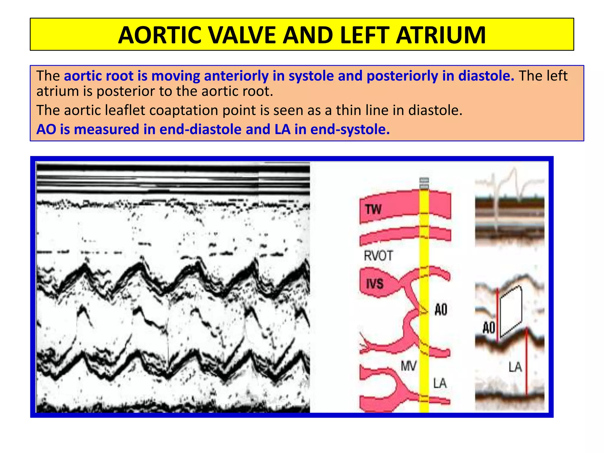 Apical Window2-Chamber ViewThis view shows the LV, the LA and the MV. The LV shows the inferior wall on the left and the anterior wall on the right.