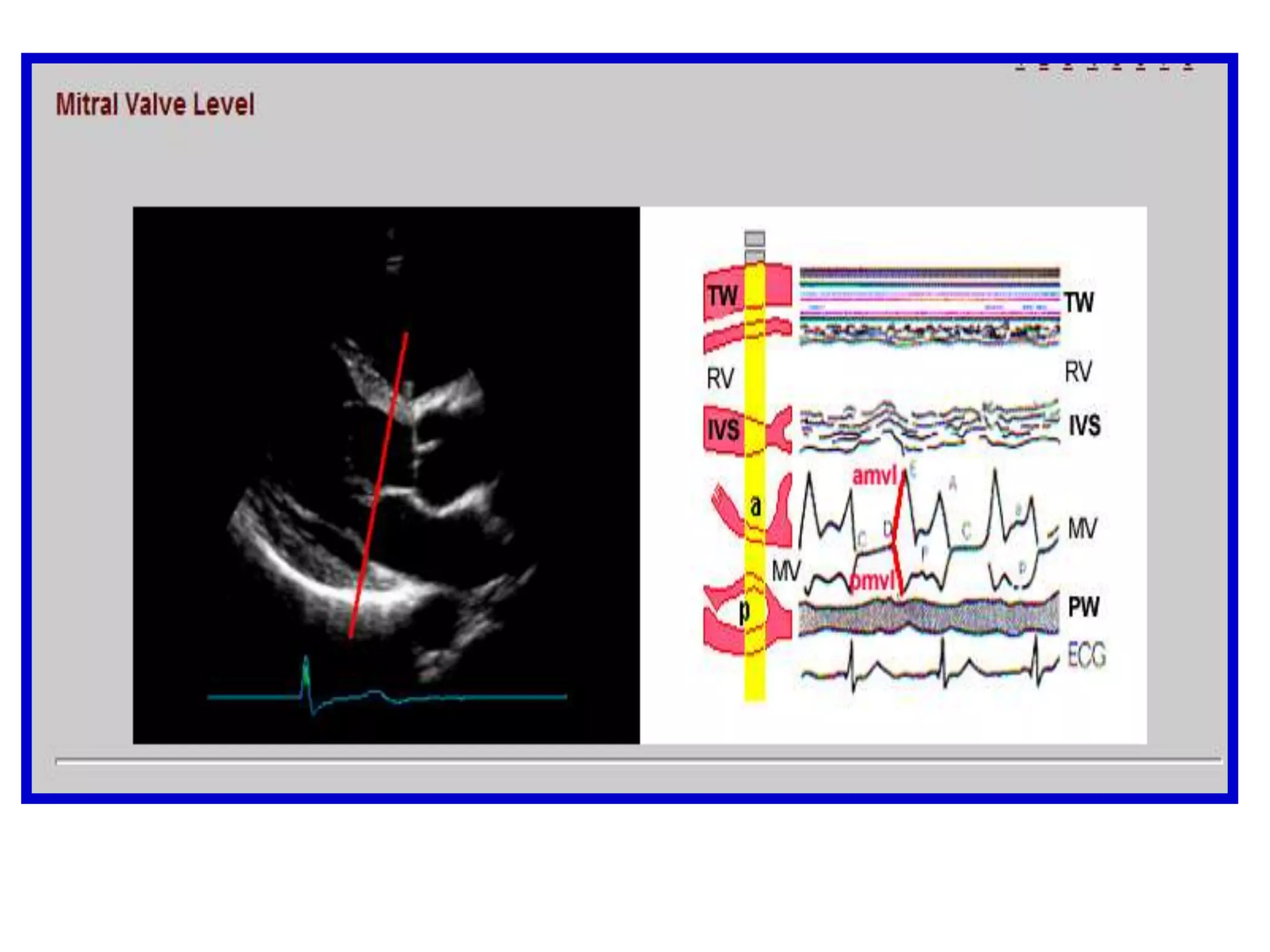 Subcostal Window4-Chamber ViewSweeping starts at the apex which appears on the right of the screen. A view of all four chambers shows the right ventricular free wall, the midsection of the interventricular septum and the posterolateral left ventricular wall. In this view, the interatrial septum is perpendicular to the direction of the ultrasound beam