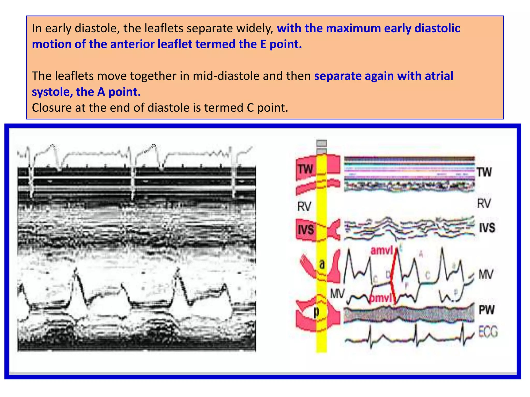 Subcostal WindowThe inferior vena cava as it enters the right atrium and the central hepatic vein are seen.