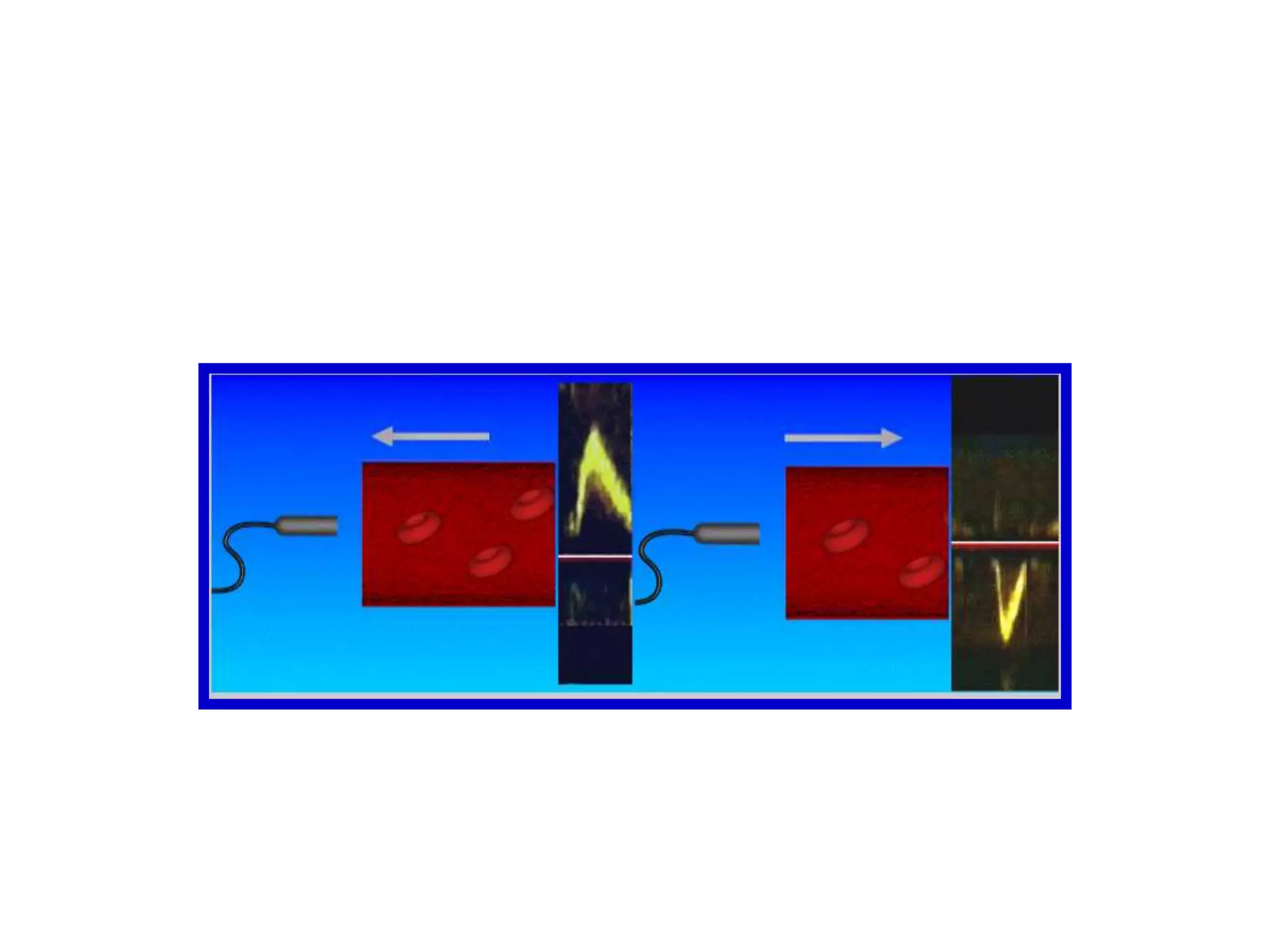 3. DOPPLER ECHOCARDIOGRAPHYBASIC PRINCIPLES:utilizes ultrasound to record blood flow within the cardiovascular system (While M-mode and 2D echo create ultrasonic images of the heart)is based upon the changes in frequency of the backscatter signal from small moving structures, ie, red blood cells, intercepted by the ultrasound beam
