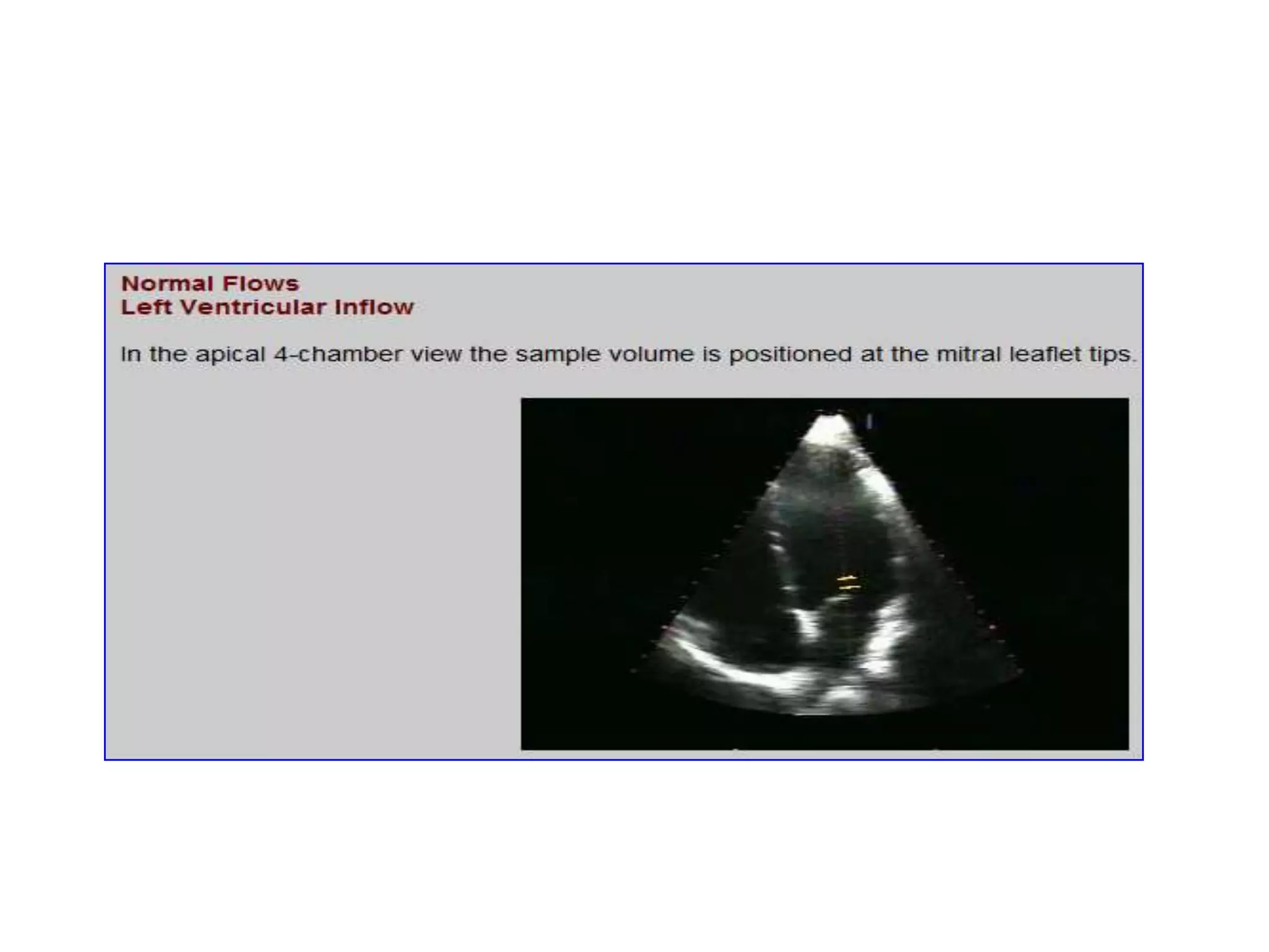   Doppler shift (F[d]) = F[r] - F[t]Doppler effect(Pairs of transmitting (T) and receiving (R) transducers):