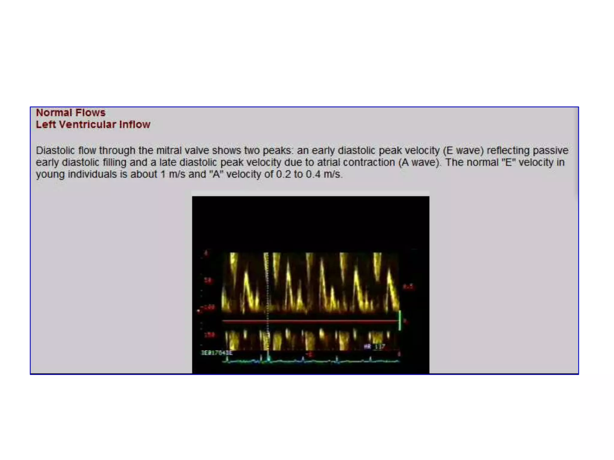   With a stationary target (panel A): the carrier frequency [f(t)] from the transmitting transducer strikes the target and is reflected back to the receiving transducer at the reflected frequency [f(r)], which is unaltered
