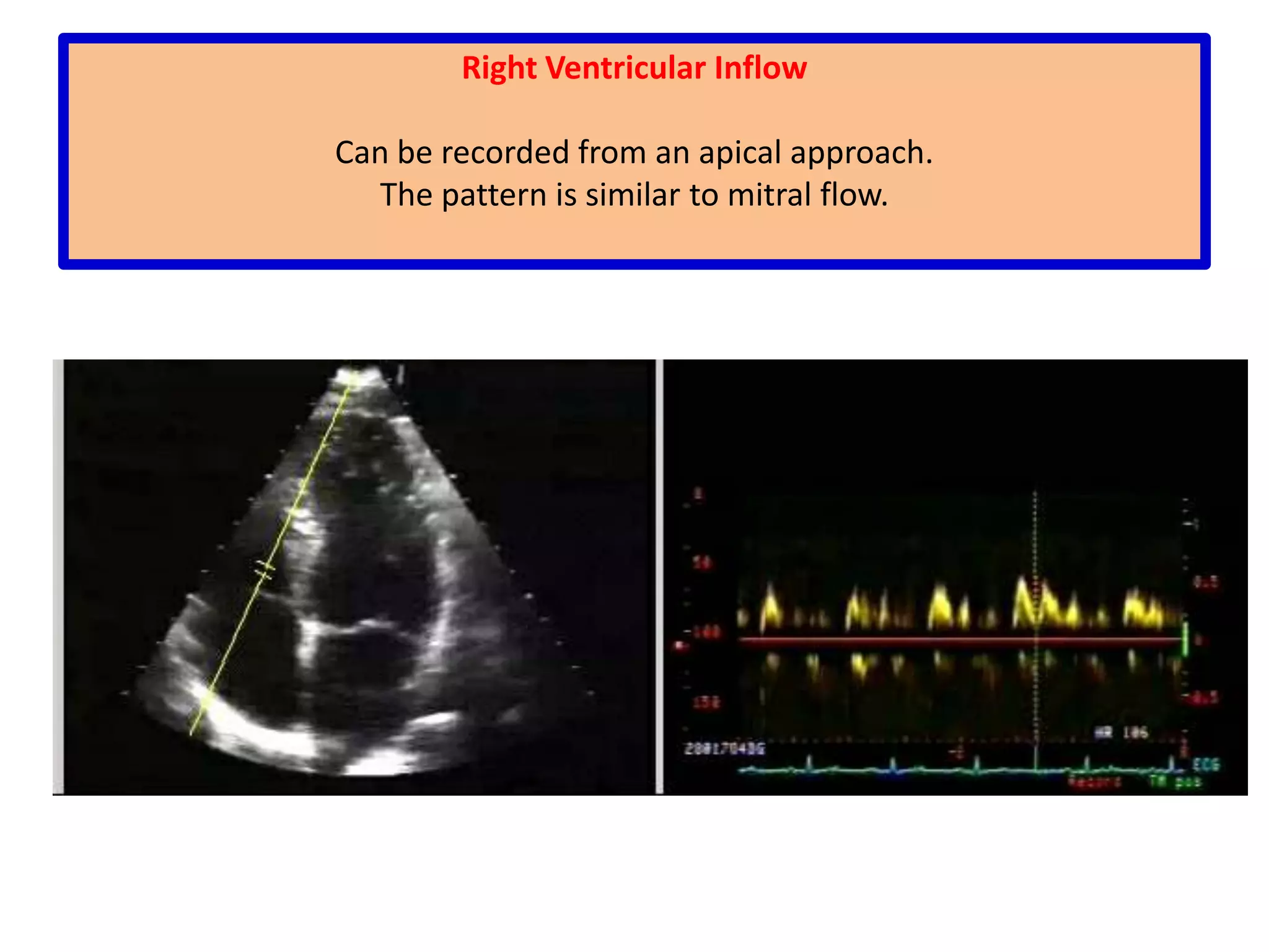   with a target moving toward the transducer (panel B):  An increase in f(r) is seen 