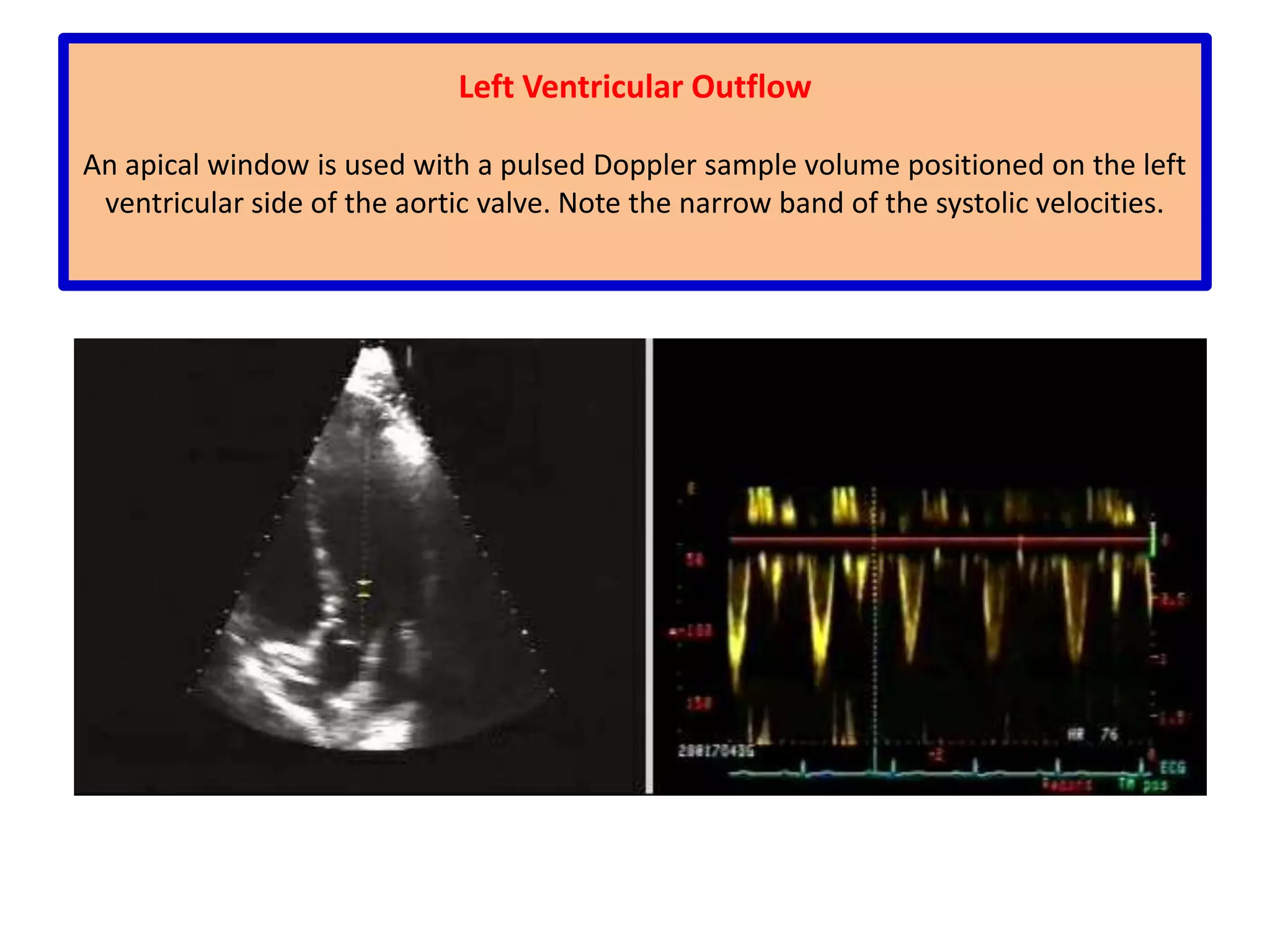   with a target moving away from the transducer (panel C): f(r) is reduced 