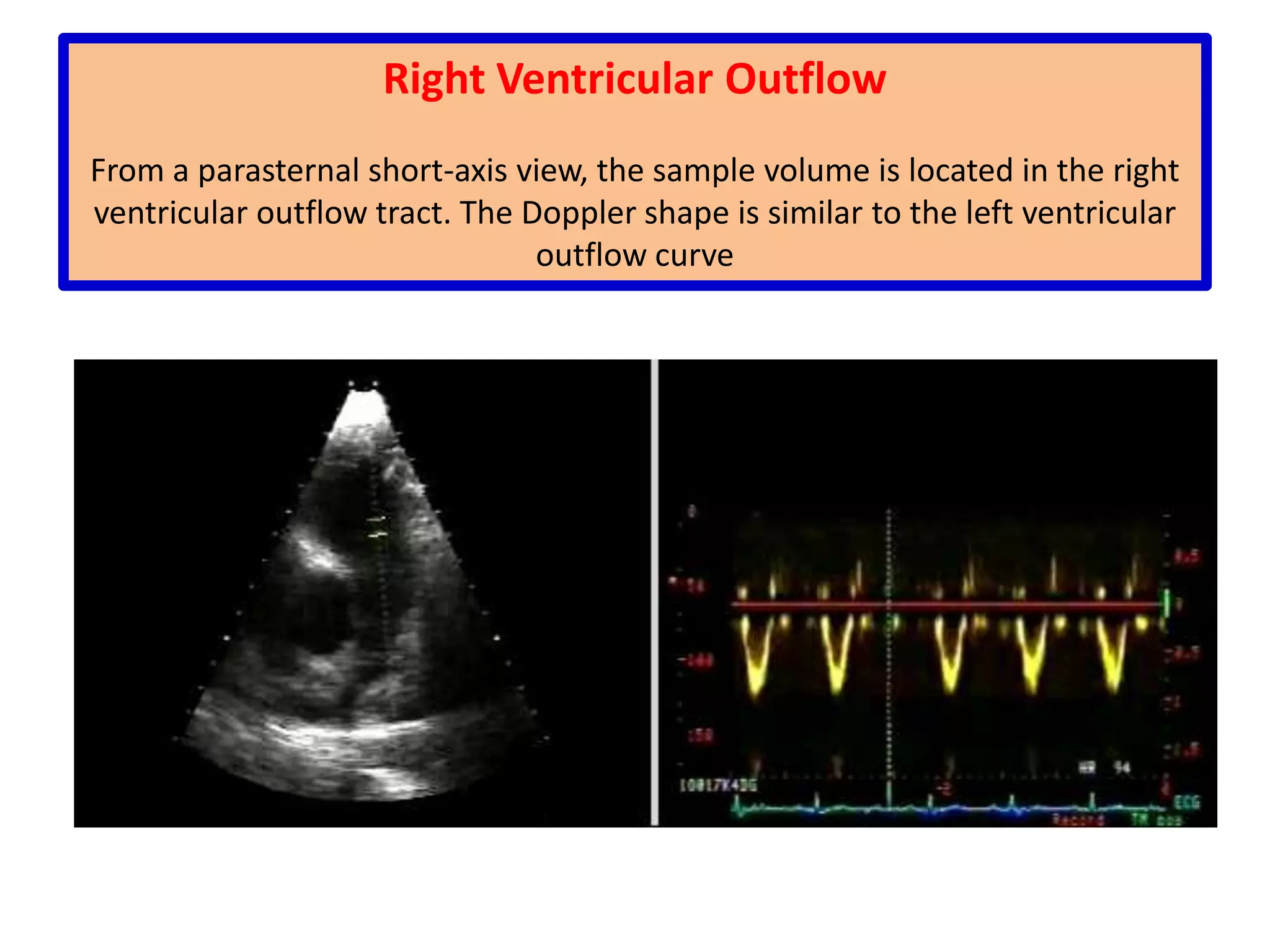 In all cases, the extent to which f(t) is increased or reduced is proportional to the velocity of the targetA flow moving toward the transducer has a higher observed frequency than a flow moving away from the transducer.