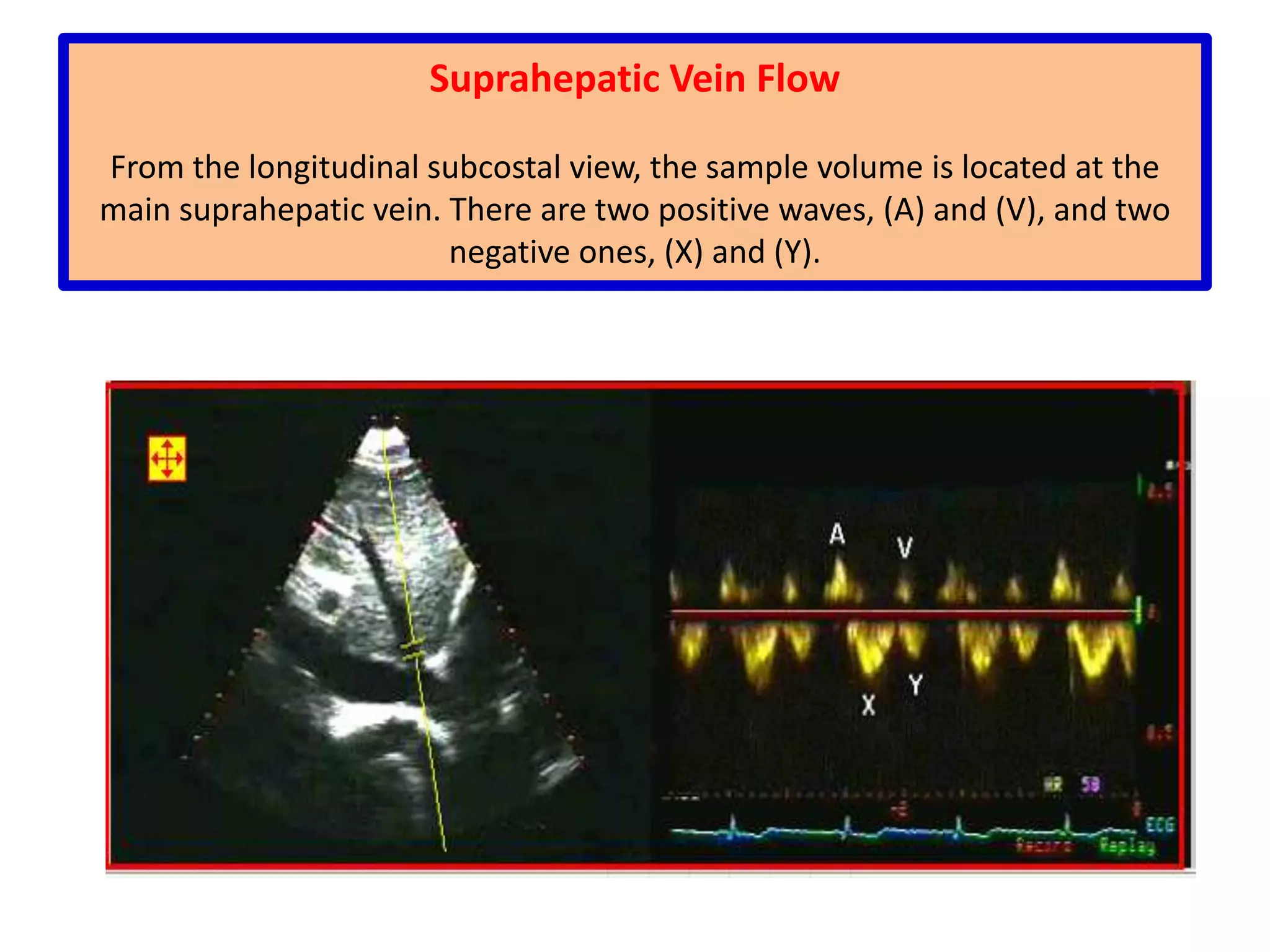 Blood flow velocity (V) is related to the Doppler shift by the speed of sound in blood (C) and ø (the intercept angle between the ultrasound beam and the direction of blood flow)A factor of 2 is used to correct for the "round-trip" transit time to and from the transducer.