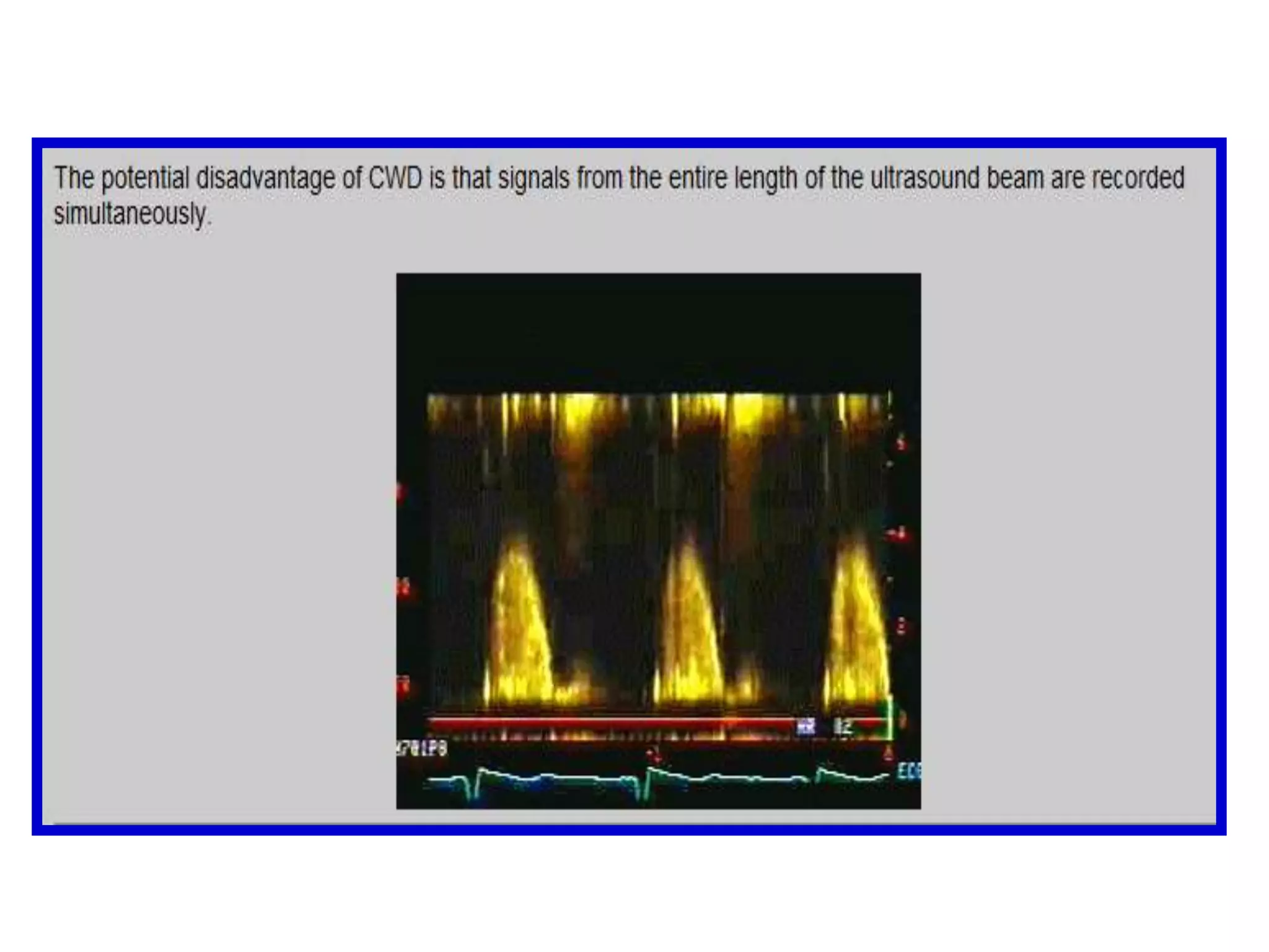 For ø of 60º, cosine ø = 0.50 The value of ø is particularly important for accurate assessment of high velocity jets, which occur in aortic stenosis or pulmonary artery hypertensionIt is generally assumed that ø is 0º and cos ø is therefore 1Ideally, the beam should be placed parallel to blood flow