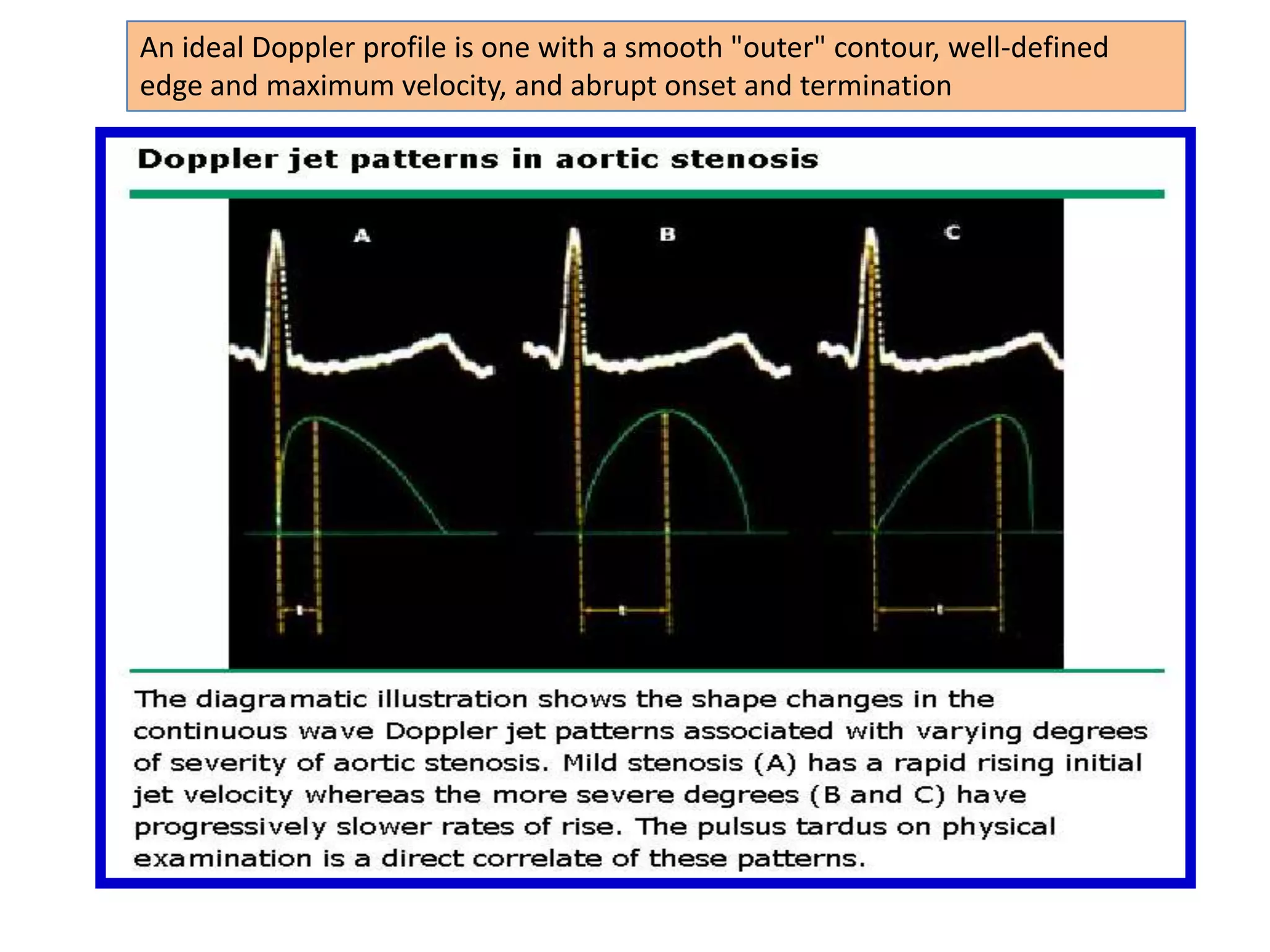 When the beam does not lie parallel, it is possible to introduce a correction into the calculation of flow velocity by measuring the cosine of the angle of interrogation and introducing this value into the Doppler equationSPECTRAL ANALYSIS When the backscattered signal is received by the transducer, the difference between the transmitted and backscattered signal is determined by comparing the two waveforms with the frequency content analyzed by:                     fast Fourier transform (FFT)The display generated by this frequency analysis is termed spectral analysis