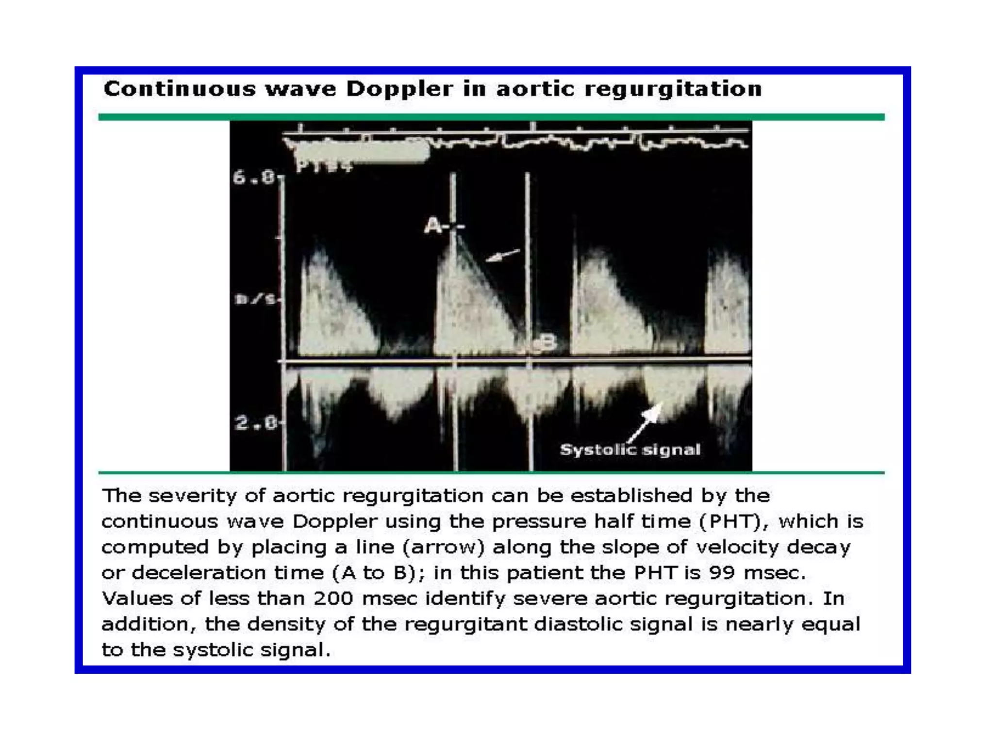 Shifts toward the transducer are represented as "positive" deflections from the "zero" baseline, and shifts away from the transducer are displayed as "negative" deflections  Spectral information can be displayed in real time (Doppler figure)The Doppler signal portrays the entire period of flow, ie: acceleration (a), peak flow (pf), and deceleration (d). 