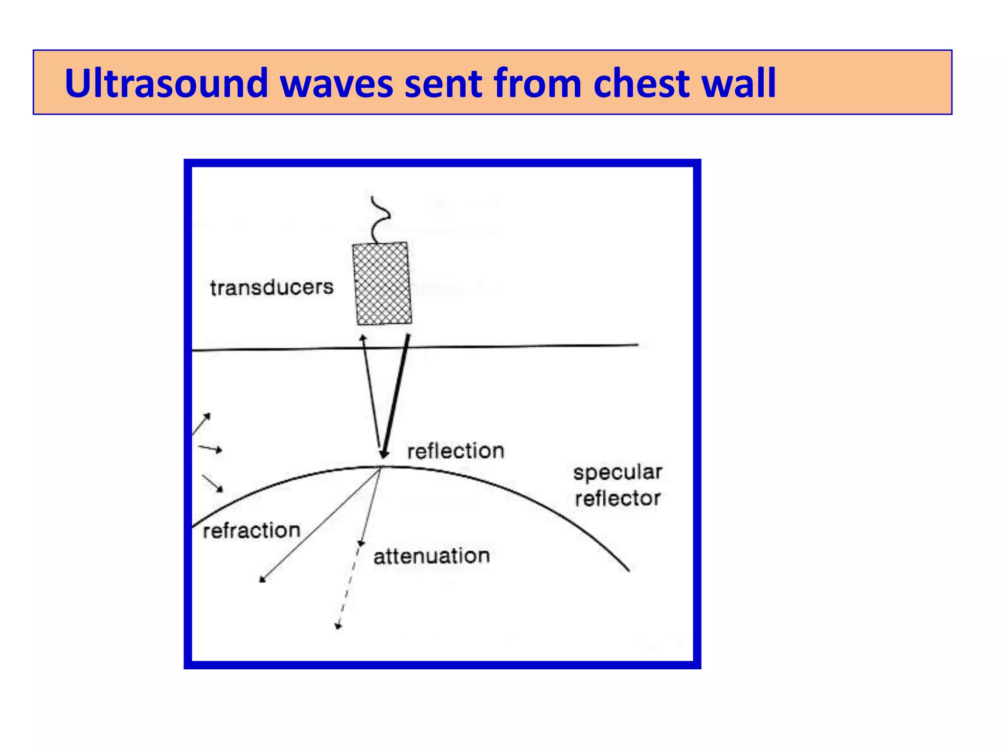 Unlike a reflected beam, scattering results in the US beam being radiated in all directions, with minimal signal returning to the transducerRefraction: Attenuation:Signal strength is progressively reduced due to absorption of the US energy by conversion to heat (frequency and, wavelength dependent)