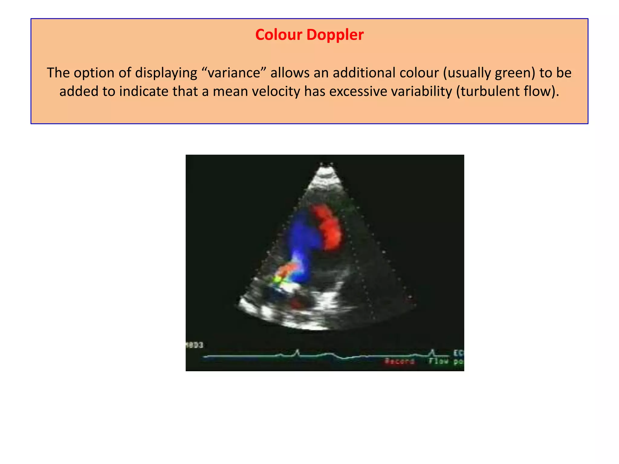 Left Ventricular OutflowAn apical window is used with a pulsed Doppler sample volume positioned on the left ventricular side of the aortic valve. Note the narrow band of the systolic velocities.