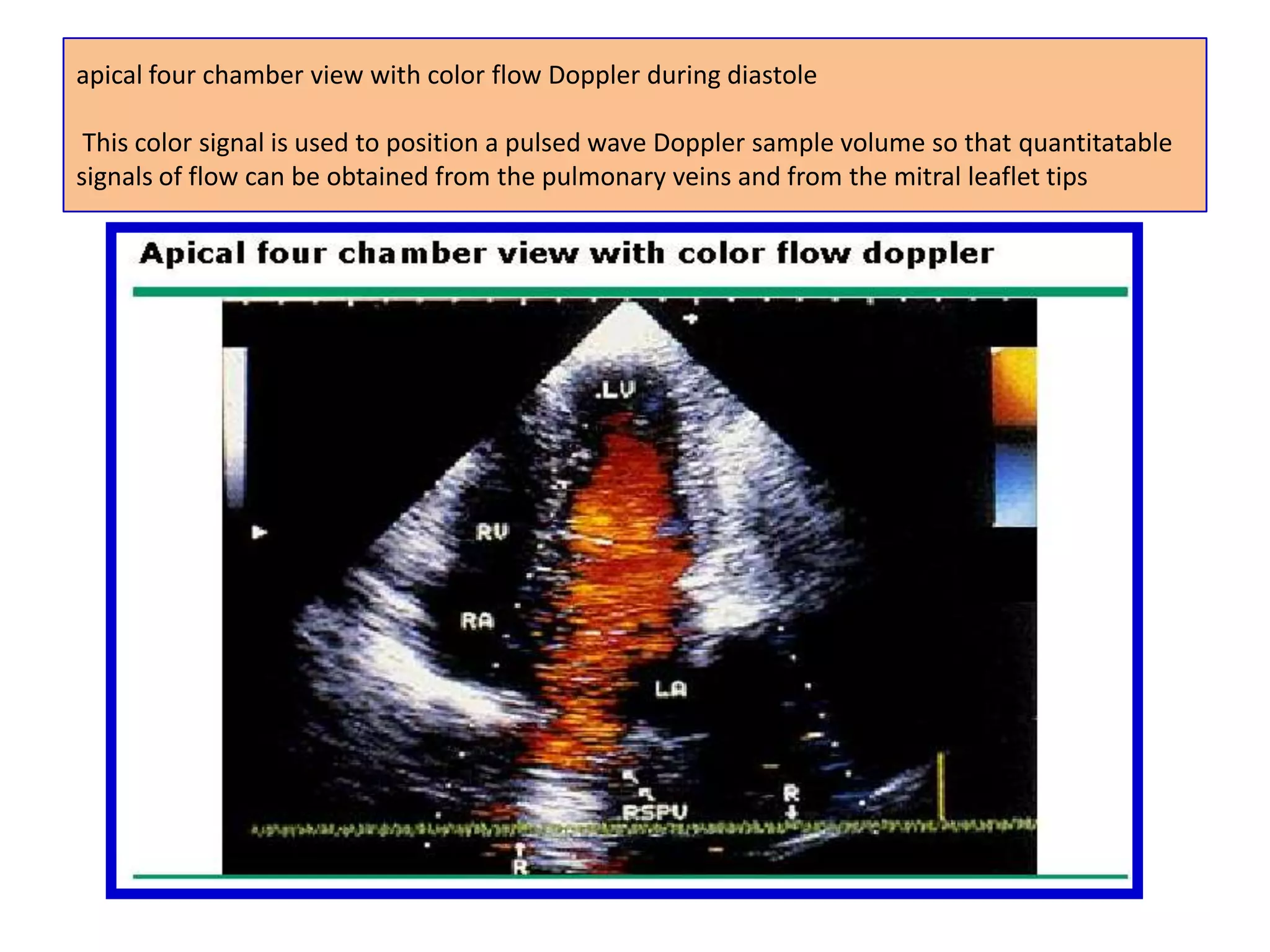 Right Ventricular OutflowFrom a parasternal short-axis view, the sample volume is located in the right ventricular outflow tract. The Doppler shape is similar to the left ventricular outflow curve