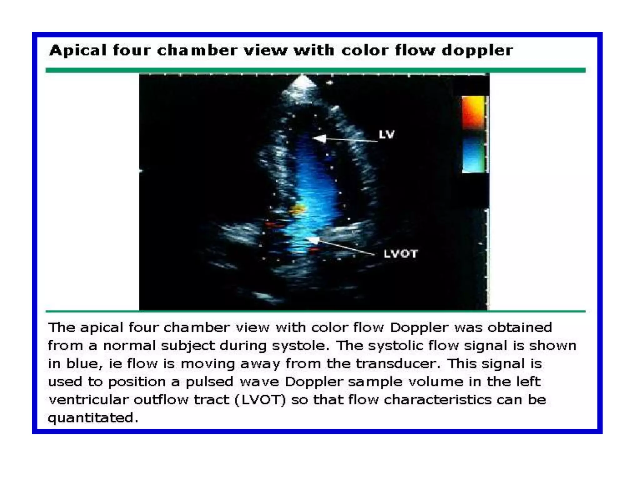 Suprahepatic Vein FlowFrom the longitudinal subcostal view, the sample volume is located at the main suprahepatic vein. There are two positive waves, (A) and (V), and two negative ones, (X) and (Y).