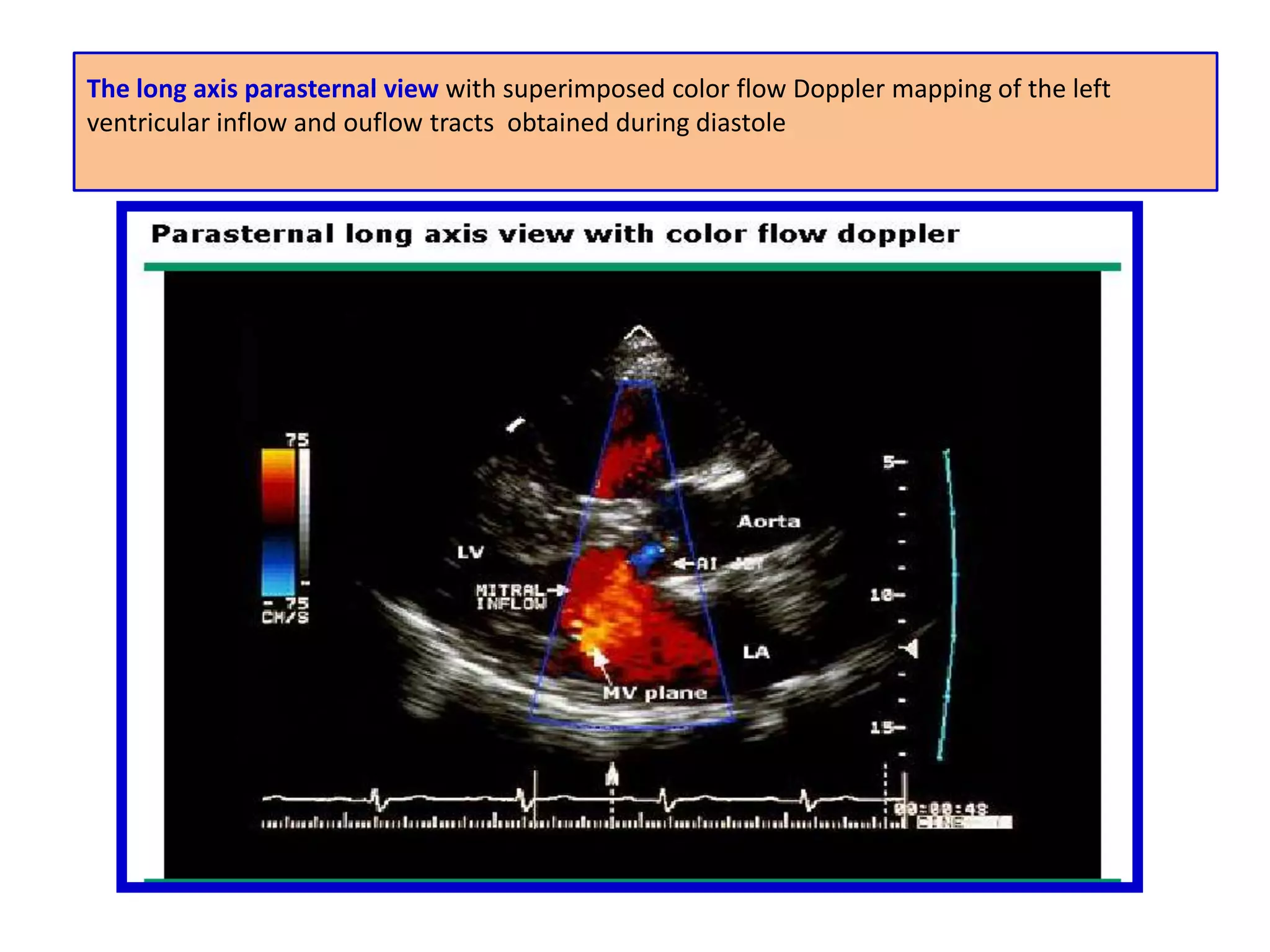 DOPPLER MODALITIES Doppler methods used for cardiac evaluation :continuous wave dopplerPulsed  wave dopplercolor flow doppler