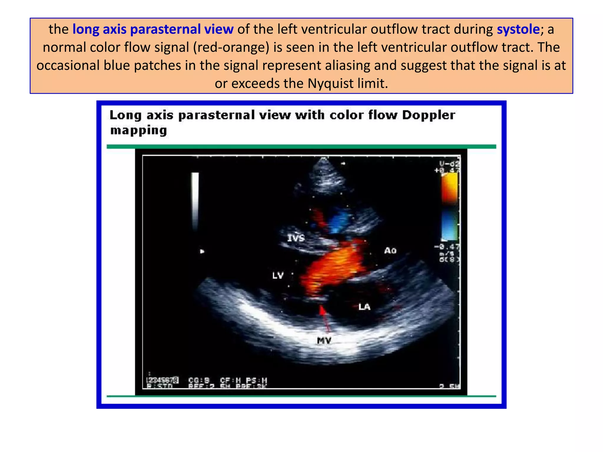 CONTINUOUS WAVE DOPPLERemploys two dedicated ultrasound crystals, one for continuous transmission and a second for continuous receptionThis permits measurement of very high frequency Doppler shifts or velocitiesLimitations of this technique: It receives a continuous signal along the entire length of the US beam