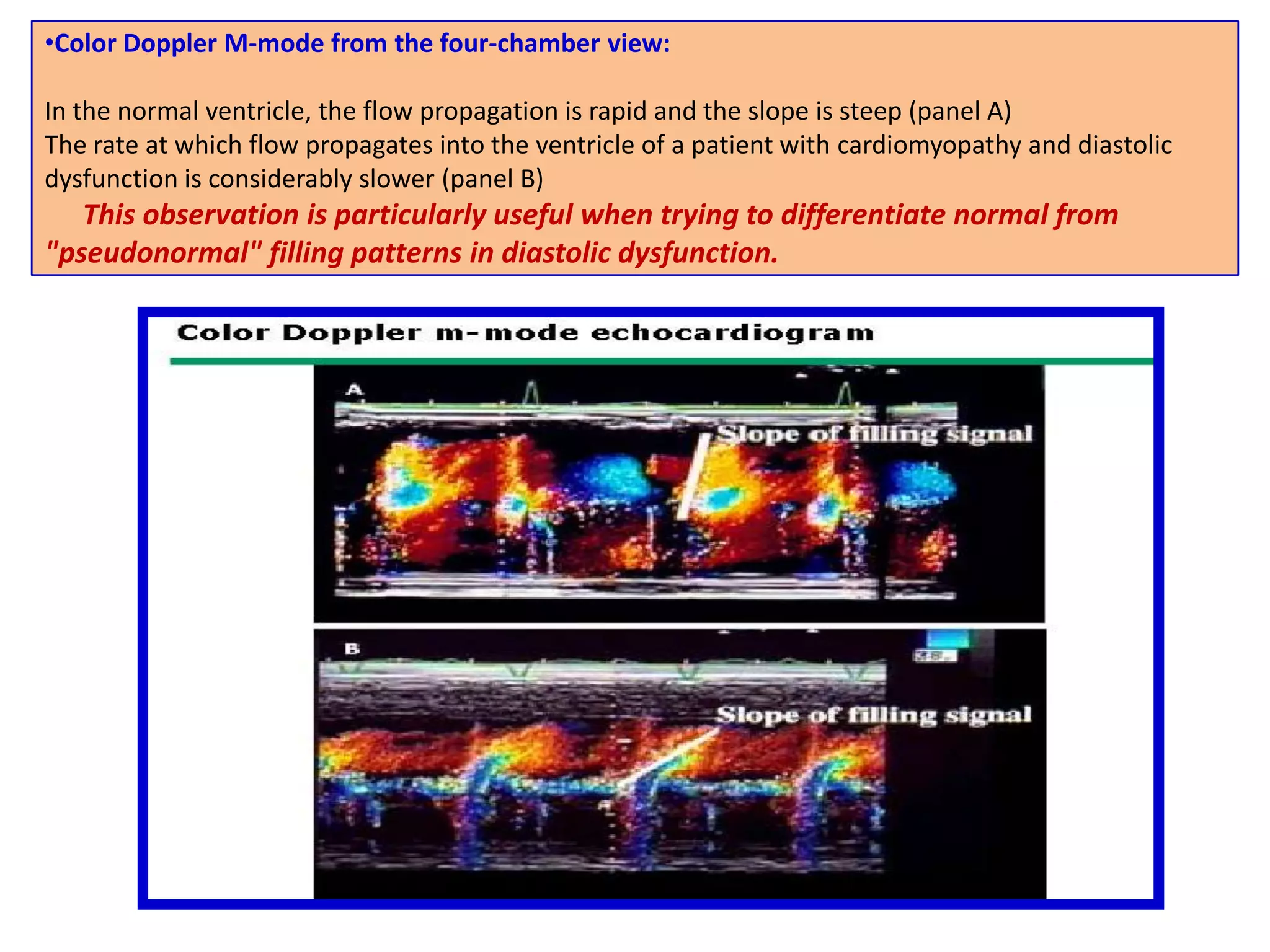 stenoses in series (eg, left ventricular outflow tract gradient and aortic stenosis) or 