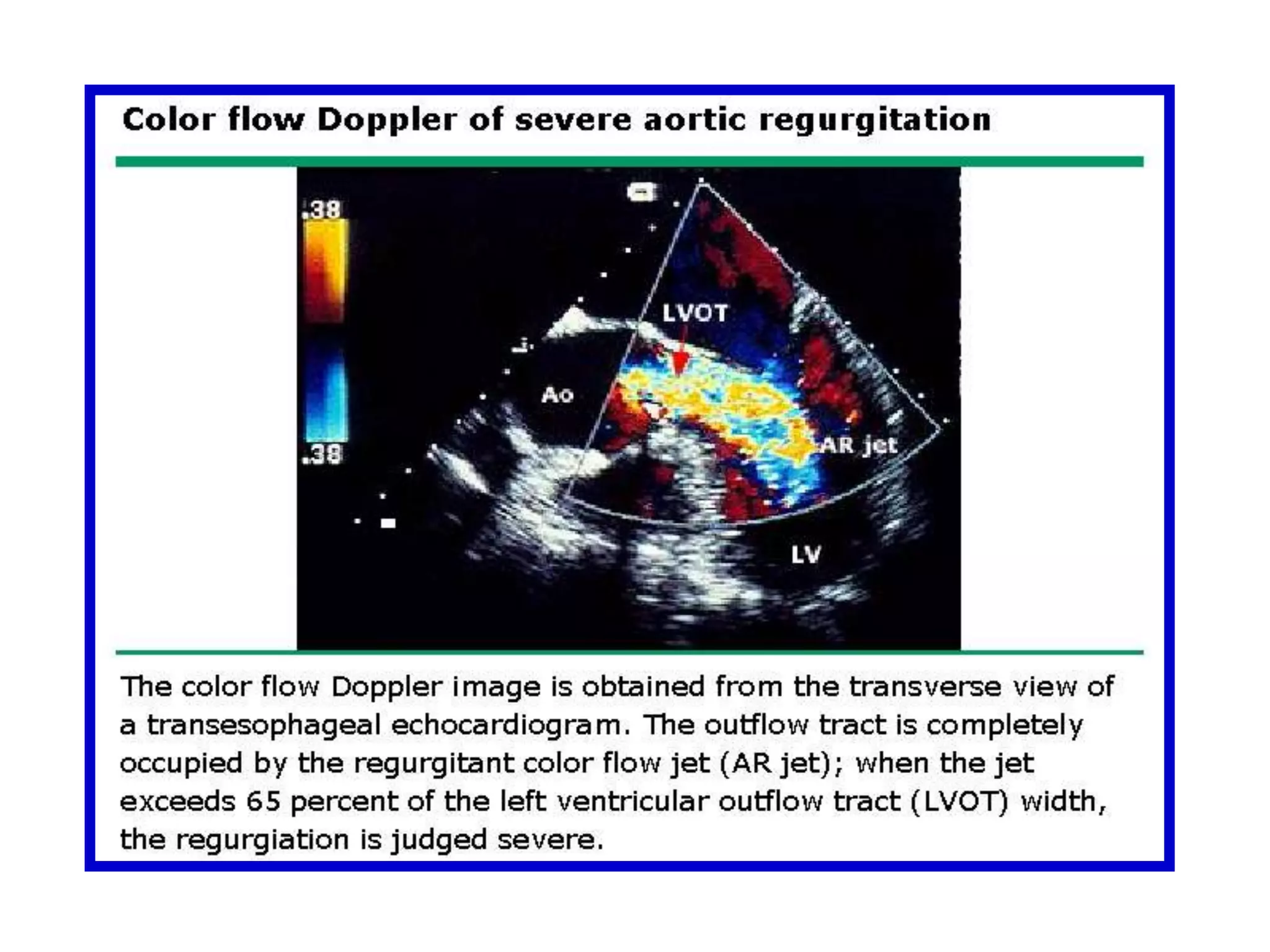 flows that are in close proximity/alignment (eg, AS and MR)