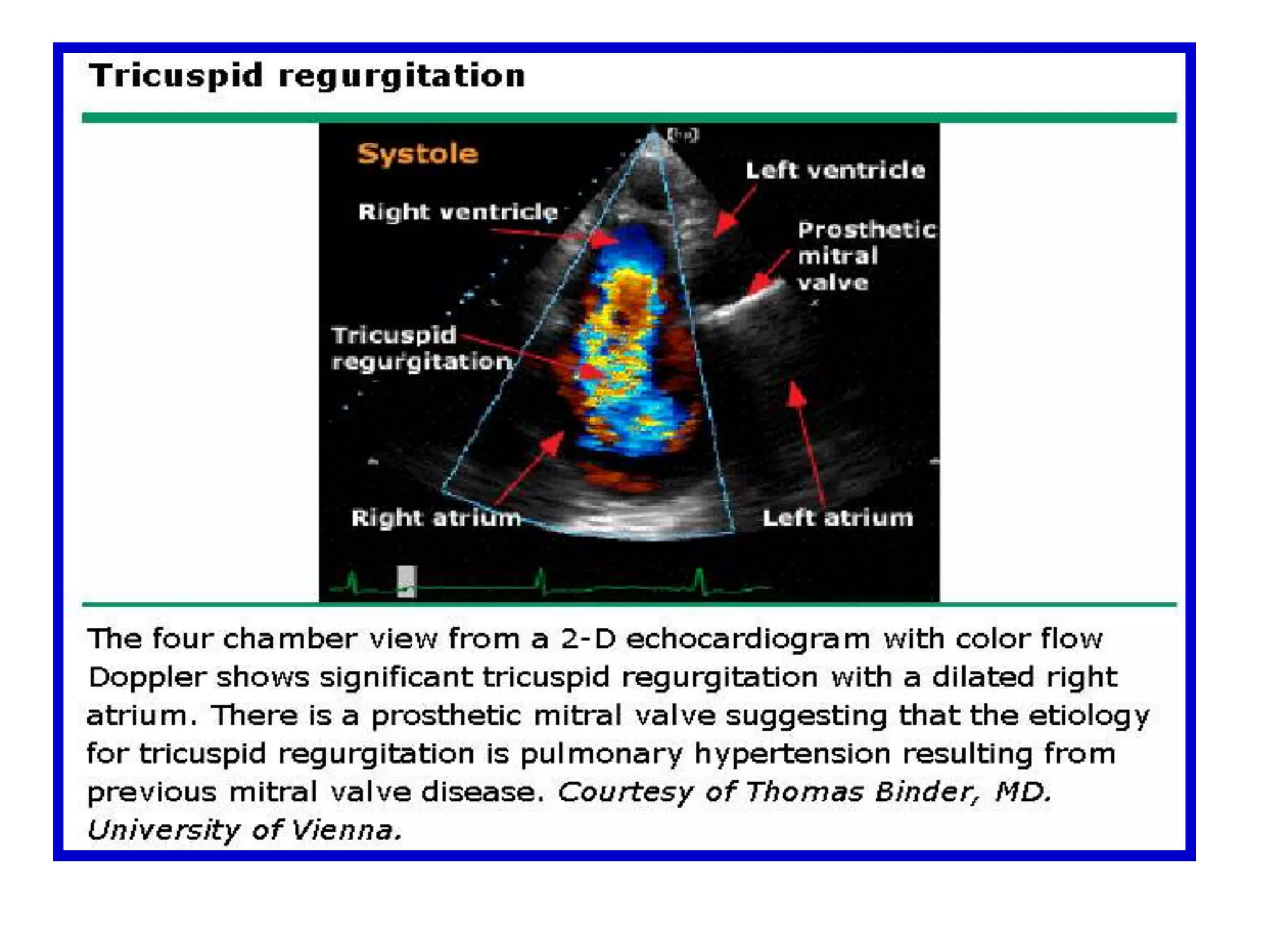 An ideal Doppler profile is one with a smooth "outer" contour, well-defined edge and maximum velocity, and abrupt onset and termination