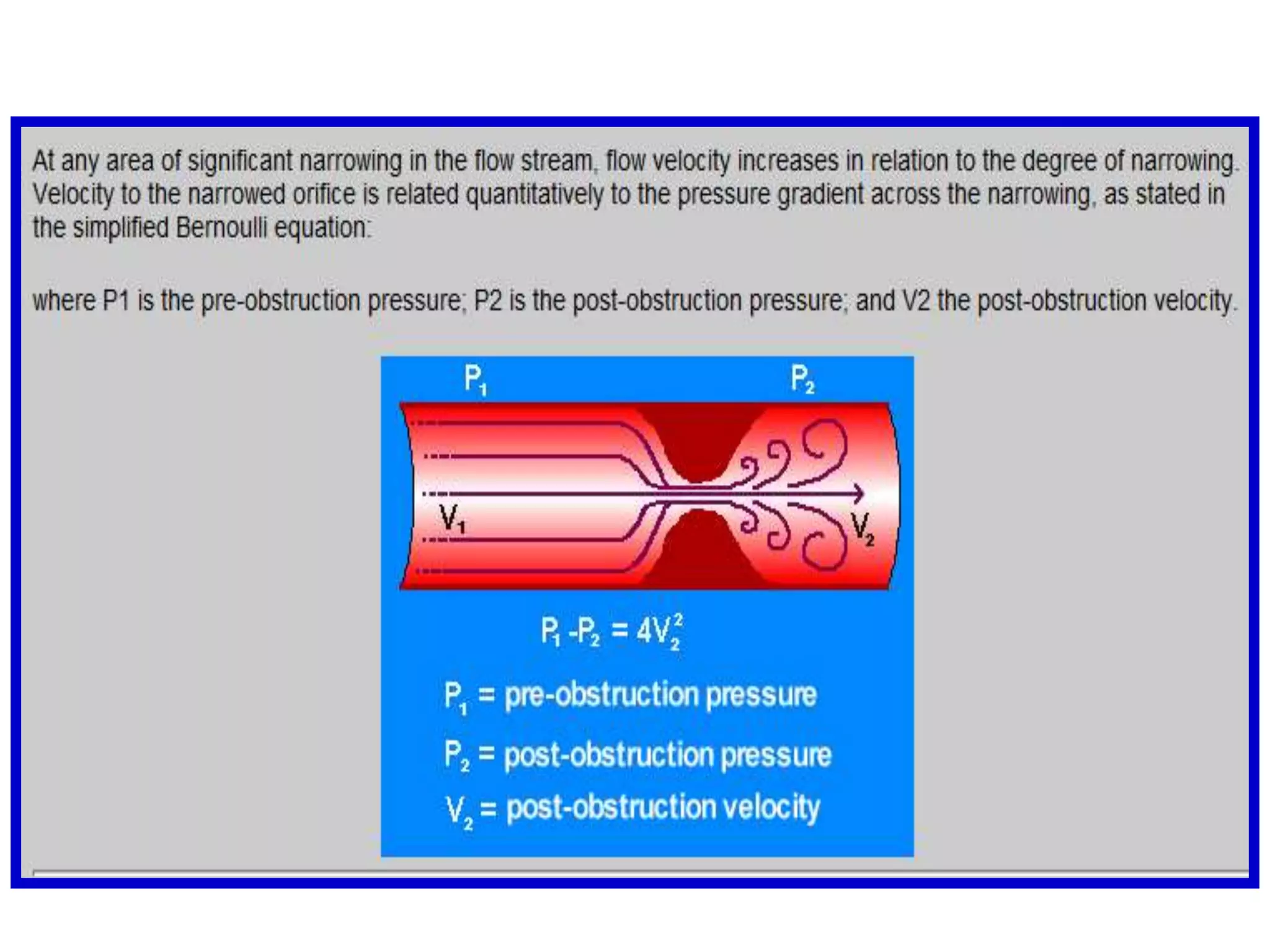 From a four-chamber view, a pulse wave Doppler signal is placed in the superior portion of the left atrium at the entry site of the right upper pulmonary veinNote that the outline of pulmonary flow signal is seen S: systolic wave;       D: diastolic wave. 