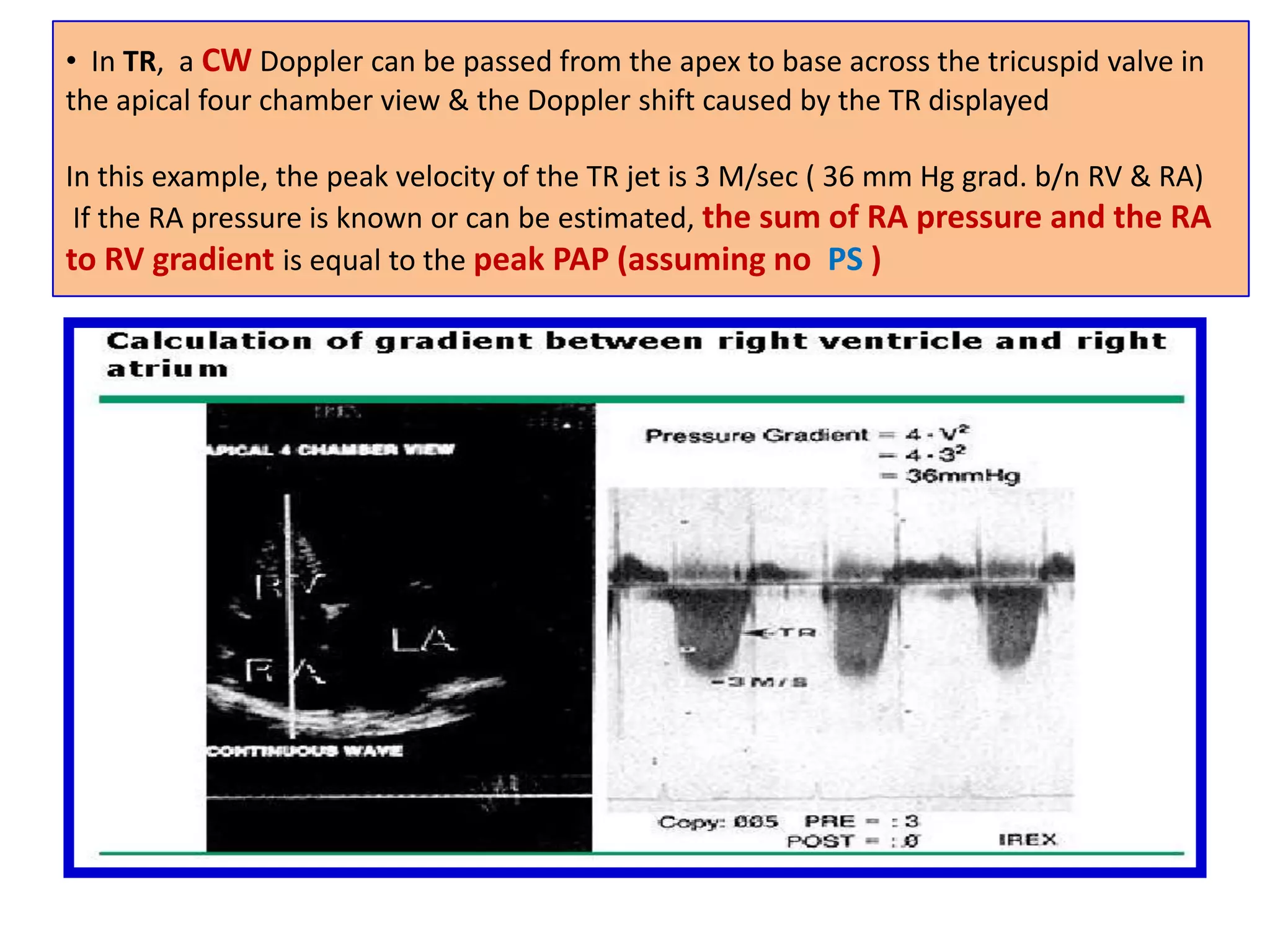 Because PWD repeatedly samples the returning signal, there is a maximum limit to the frequency shift that can be measured unambiguouslyThe maximum detectable frequency shift (the Nyquist limit) is one-half the PRFIf velocity exceeds the Nyquist limit, signal aliasing is seen with the signal cut off at the edge of the display and the top of the waveform appearing in the reverse partHigh-PRF increases the number of sample volumes
