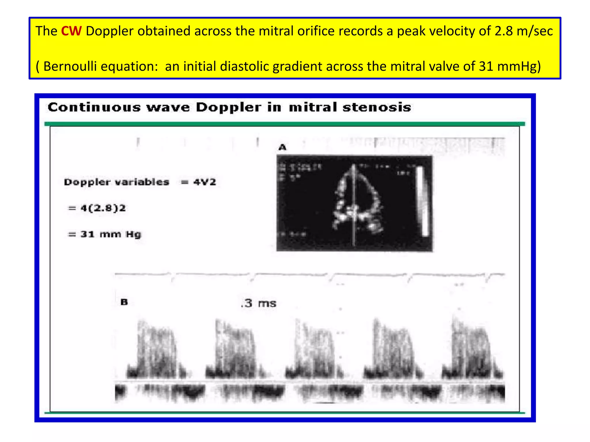 COLOR FLOW IMAGINGWith CF imaging, velocities are displayed using a color scale: