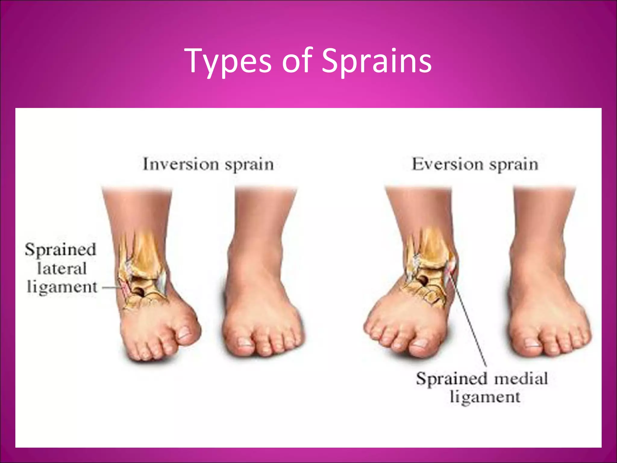 Types of Sprains 
 