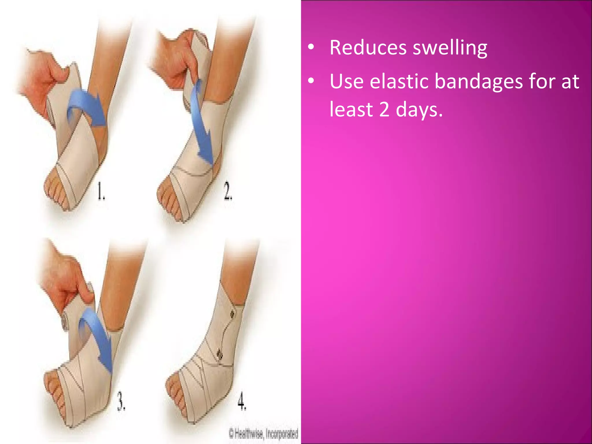 • Reduces swelling 
• Use elastic bandages for at 
least 2 days. 
 