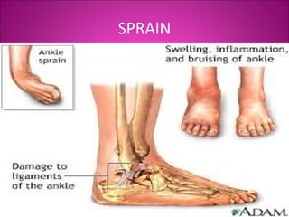 SPRAIN 
 