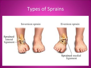 Types of Sprains 
 