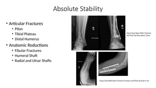 Basics of fracture healing of bones.pptx