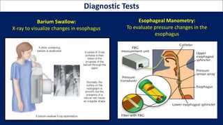 Eed Normal Basics of GERD, peptic Ulcer & Gastroparesis | PPTX