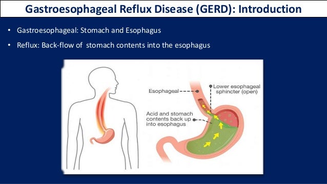 Basics Of Gerd Peptic Ulcer Gastroparesis basics of gerd peptic ulcer