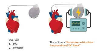 Dc Shock Pacemaker Basics of ICD - Dr Hafeesh Fazulu - Pushpagiri | PPTX