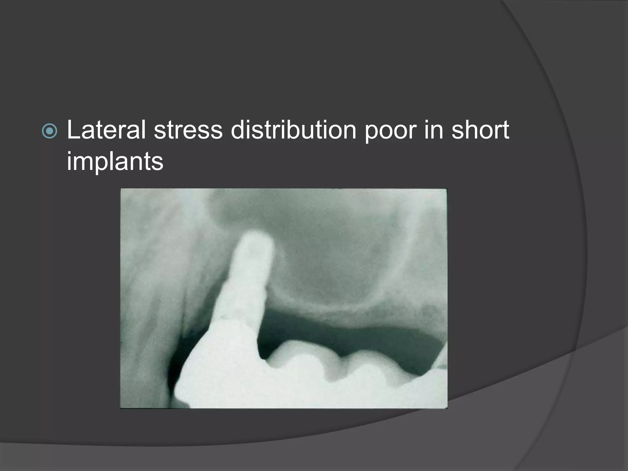  Lateral stress distribution poor in short
implants
 