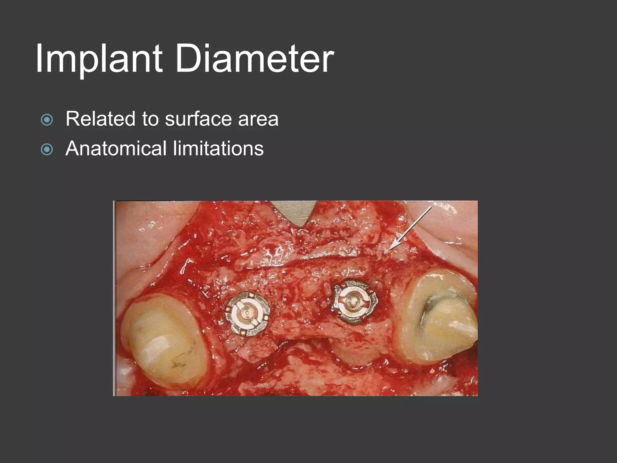 Implant Diameter
 Related to surface area
 Anatomical limitations
 