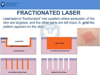 Fractioned Pattern Basics of laser UICAM (1).pptx