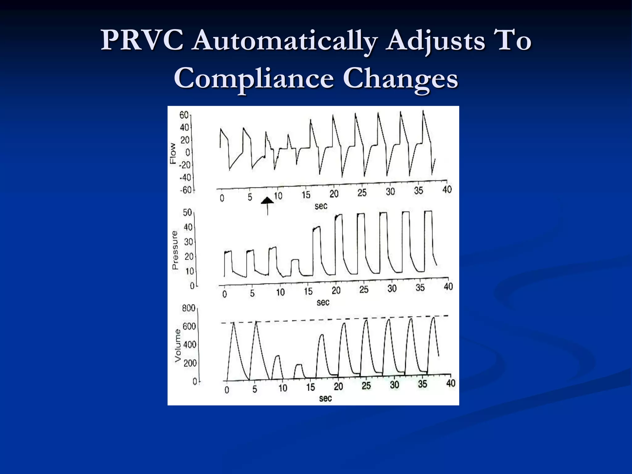 PRVC Automatically Adjusts To
Compliance Changes
 