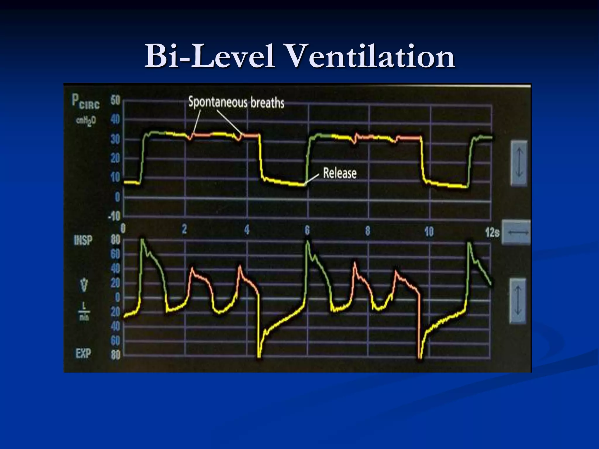 Bi-Level Ventilation
 