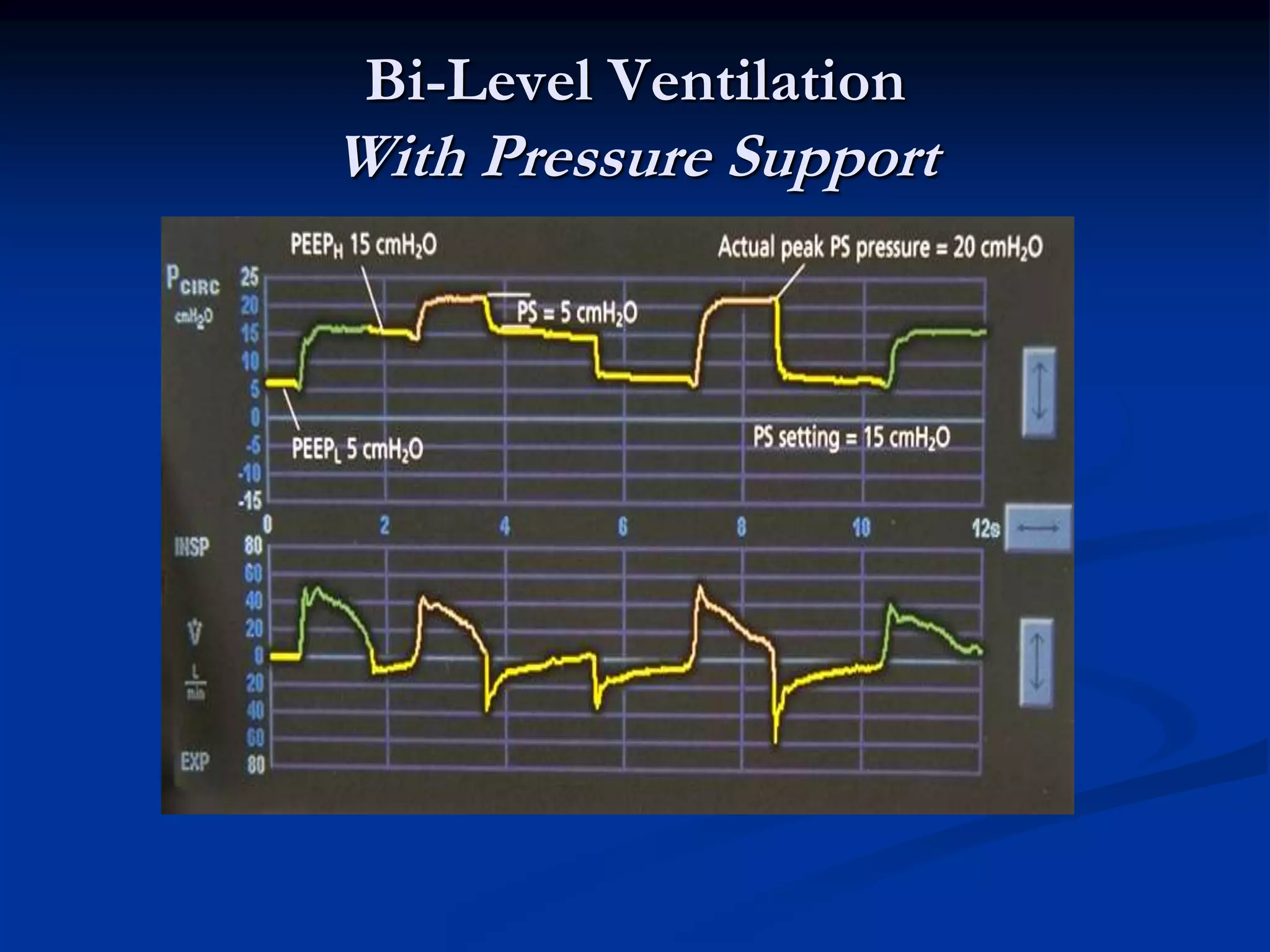Bi-Level Ventilation
With Pressure Support
 