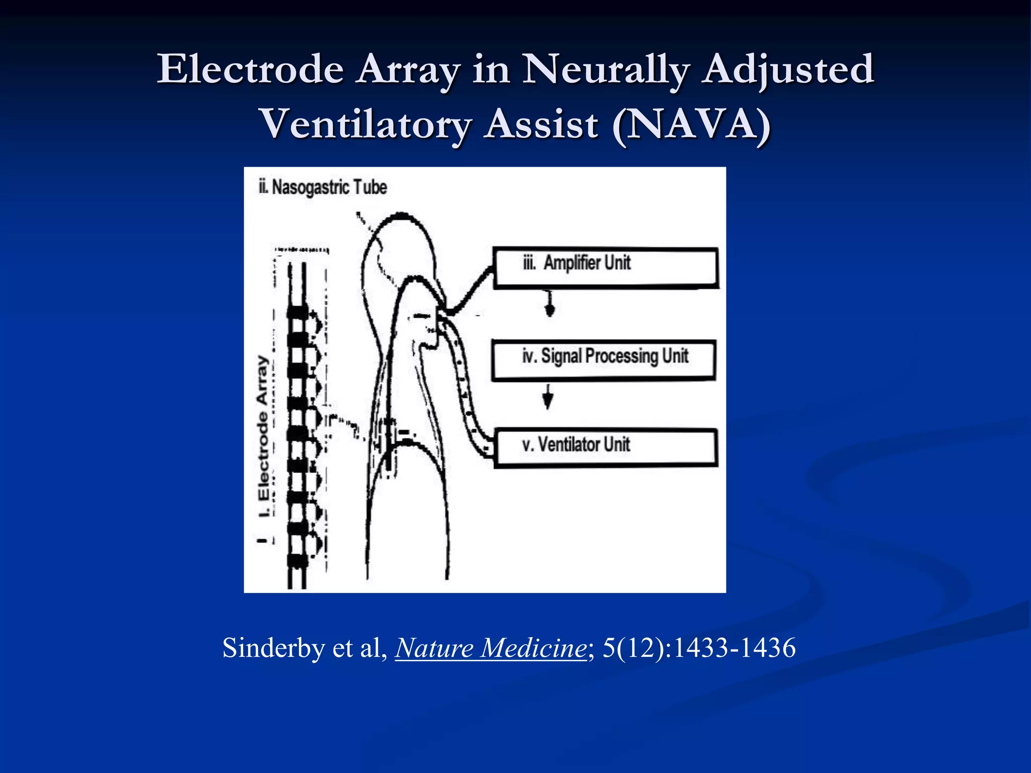 Electrode Array in Neurally Adjusted
Ventilatory Assist (NAVA)
Sinderby et al, Nature Medicine; 5(12):1433-1436
 