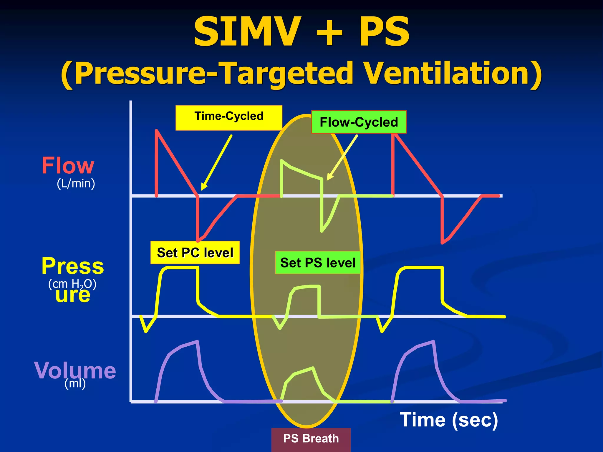 Press
ure
Flow
Volume
(L/min)
(cm H2O)
(ml)
SIMV + PS
(Pressure-Targeted Ventilation)
PS Breath
Set PS level
Set PC level
Time (sec)
Time-Cycled
Flow-Cycled
 