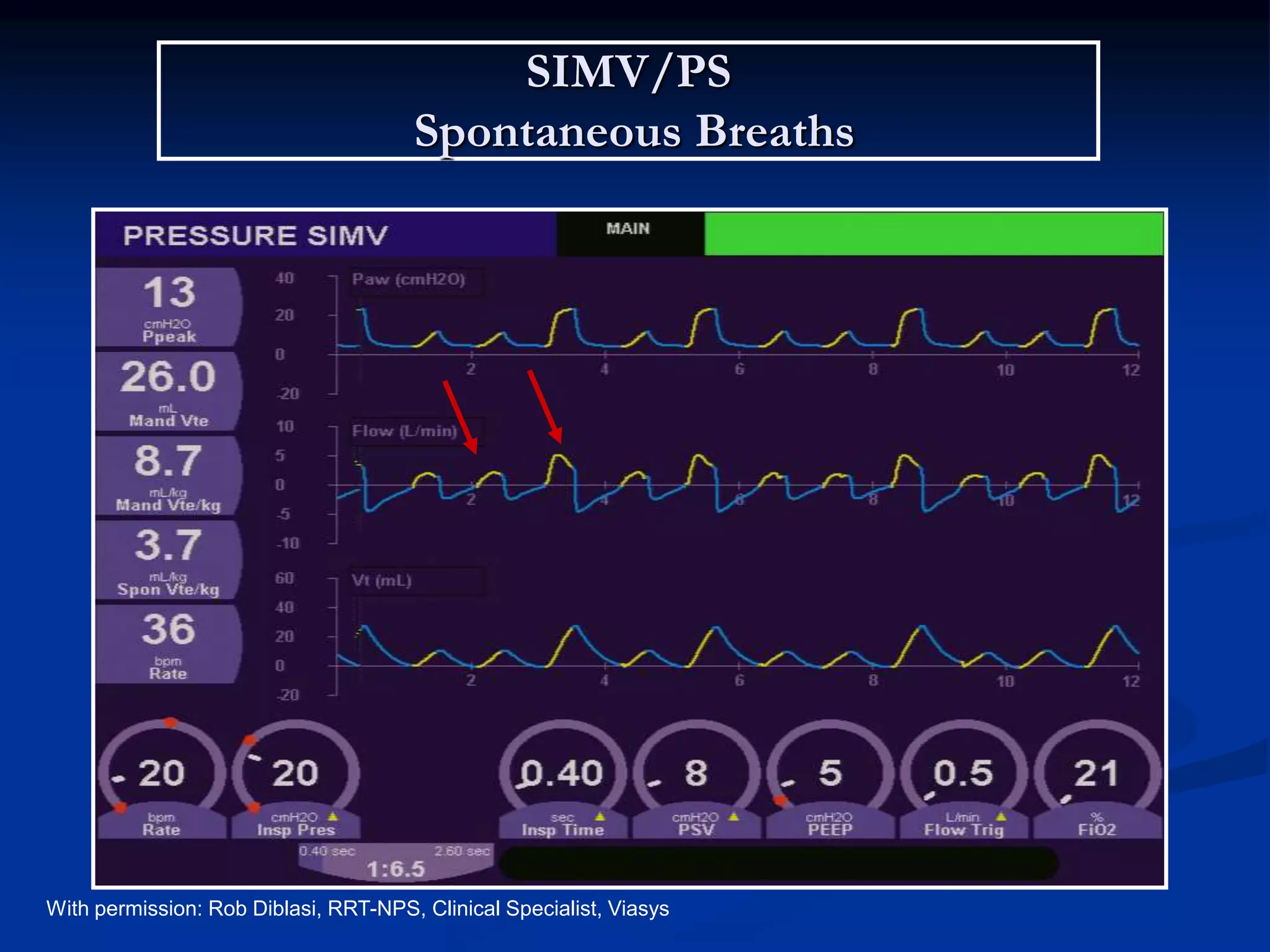 SIMV/PS
Spontaneous Breaths
With permission: Rob Diblasi, RRT-NPS, Clinical Specialist, Viasys
 