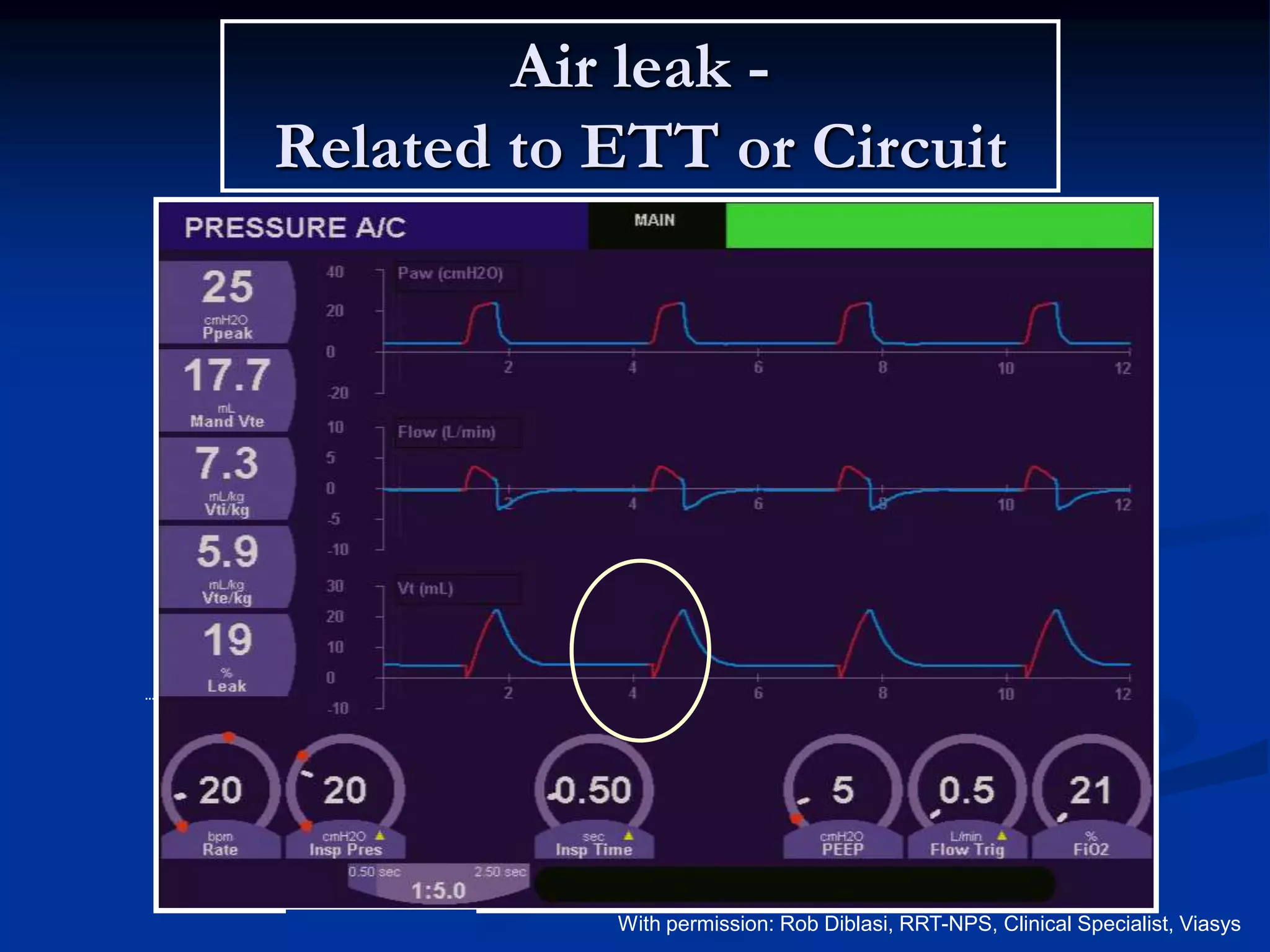 Air leak -
Related to ETT or Circuit
Volume
Pressure
Flow
Volume
Time
With permission: Rob Diblasi, RRT-NPS, Clinical Specialist, Viasys
 