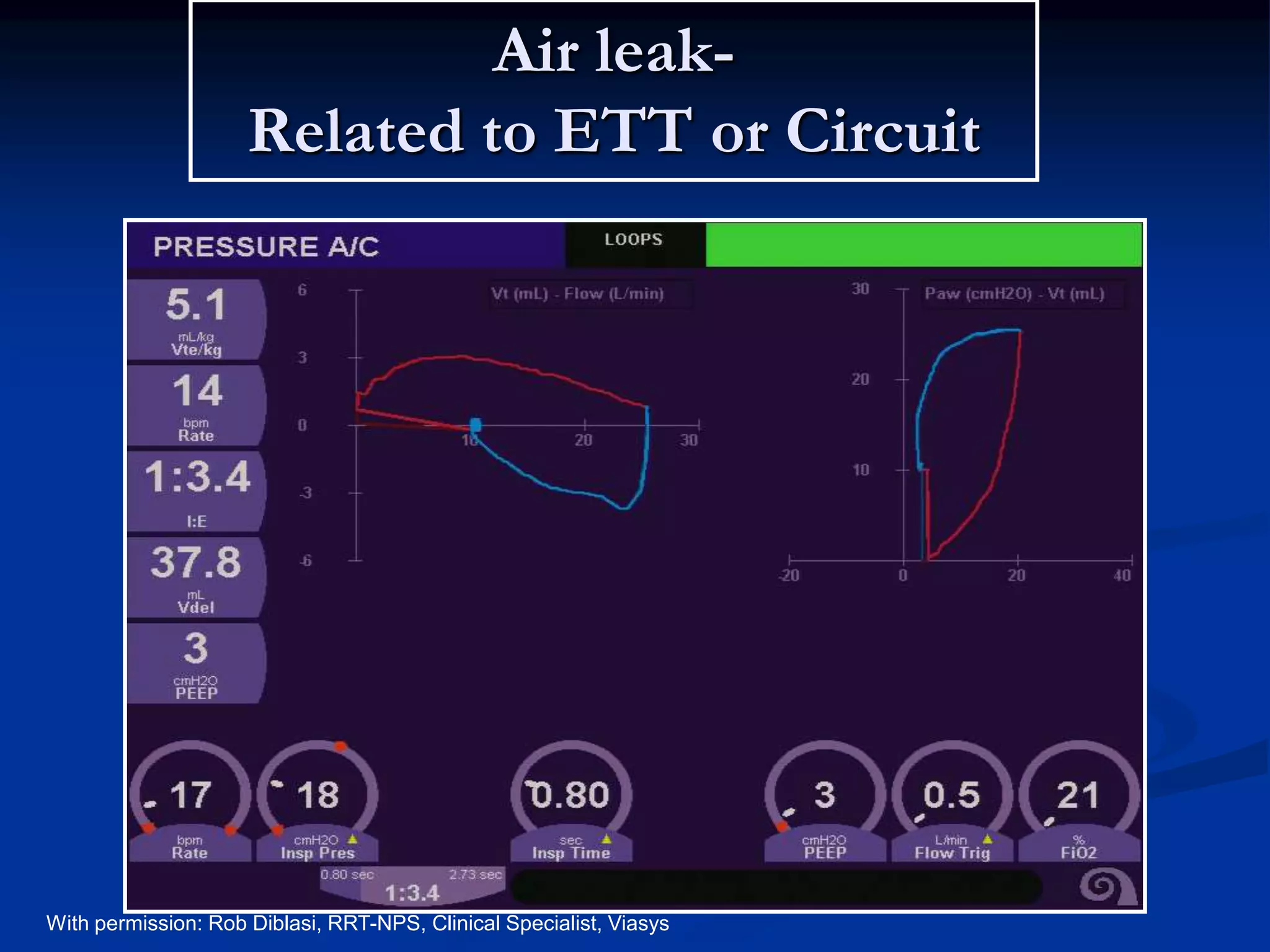 Air leak-
Related to ETT or Circuit
Volume Flow
Volume
Time
With permission: Rob Diblasi, RRT-NPS, Clinical Specialist, Viasys
 