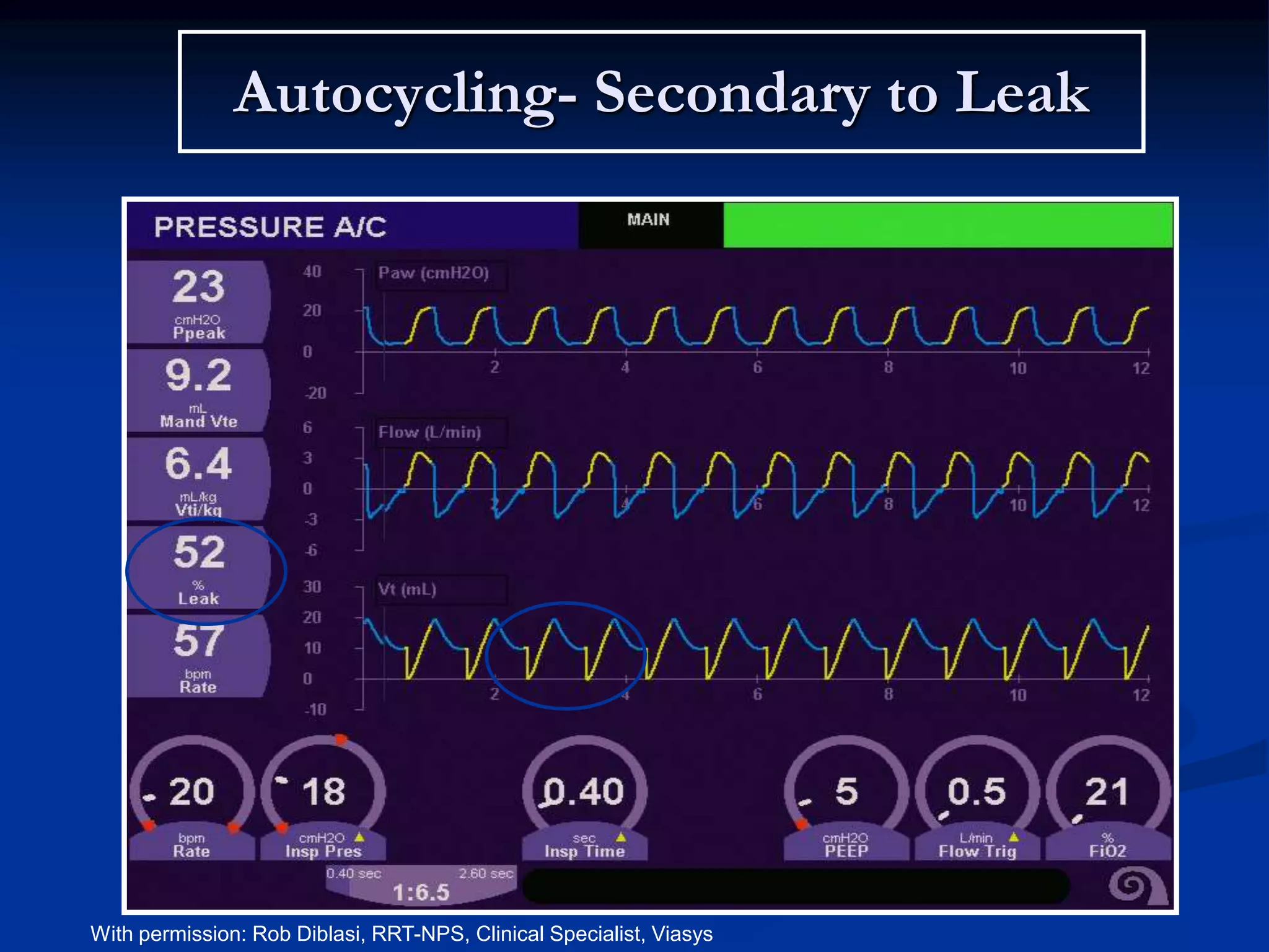 Autocycling- Secondary to Leak
With permission: Rob Diblasi, RRT-NPS, Clinical Specialist, Viasys
 