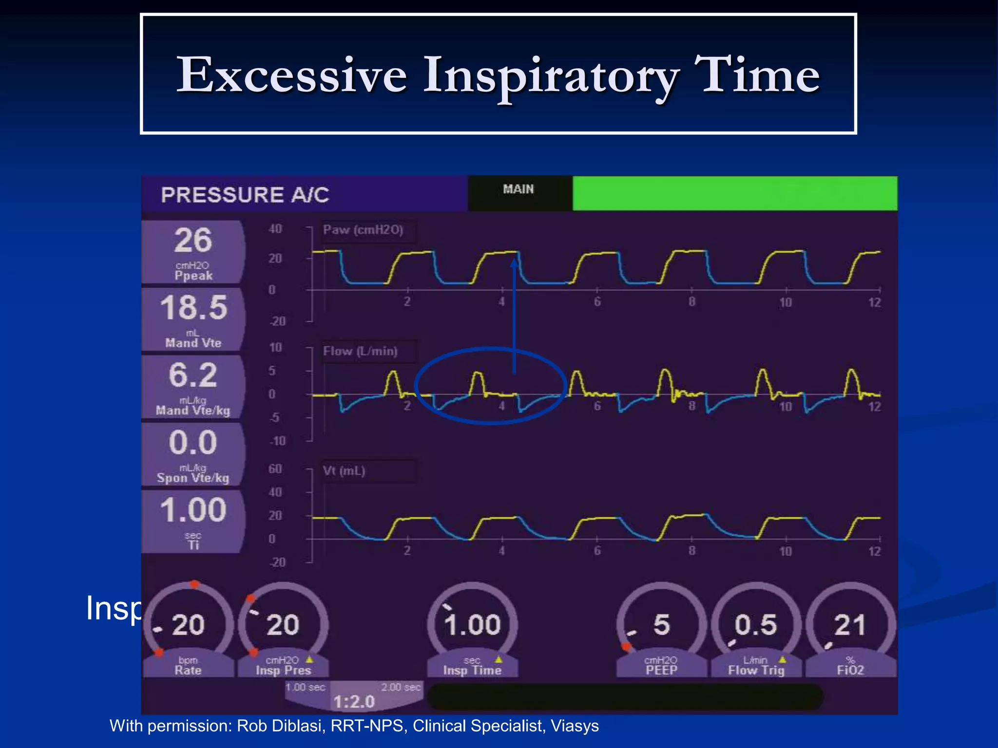 Excessive Inspiratory Time
Inspiratory Time= .5 secs
With permission: Rob Diblasi, RRT-NPS, Clinical Specialist, Viasys
 