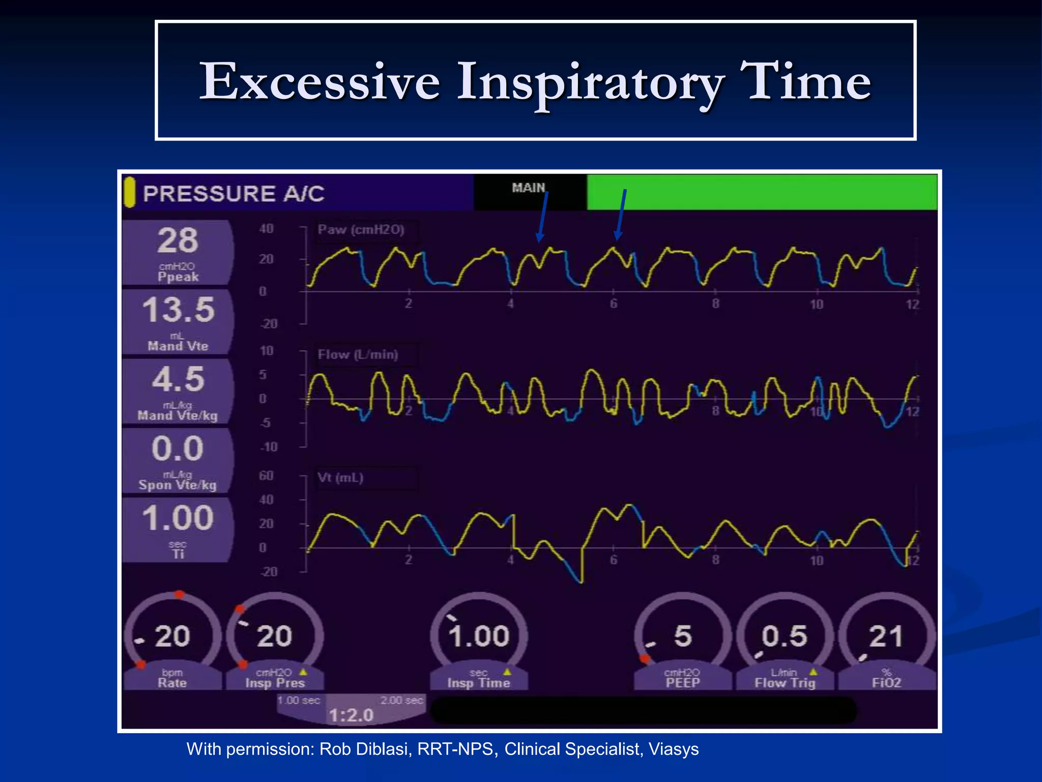Excessive Inspiratory Time
With permission: Rob Diblasi, RRT-NPS, Clinical Specialist, Viasys
 