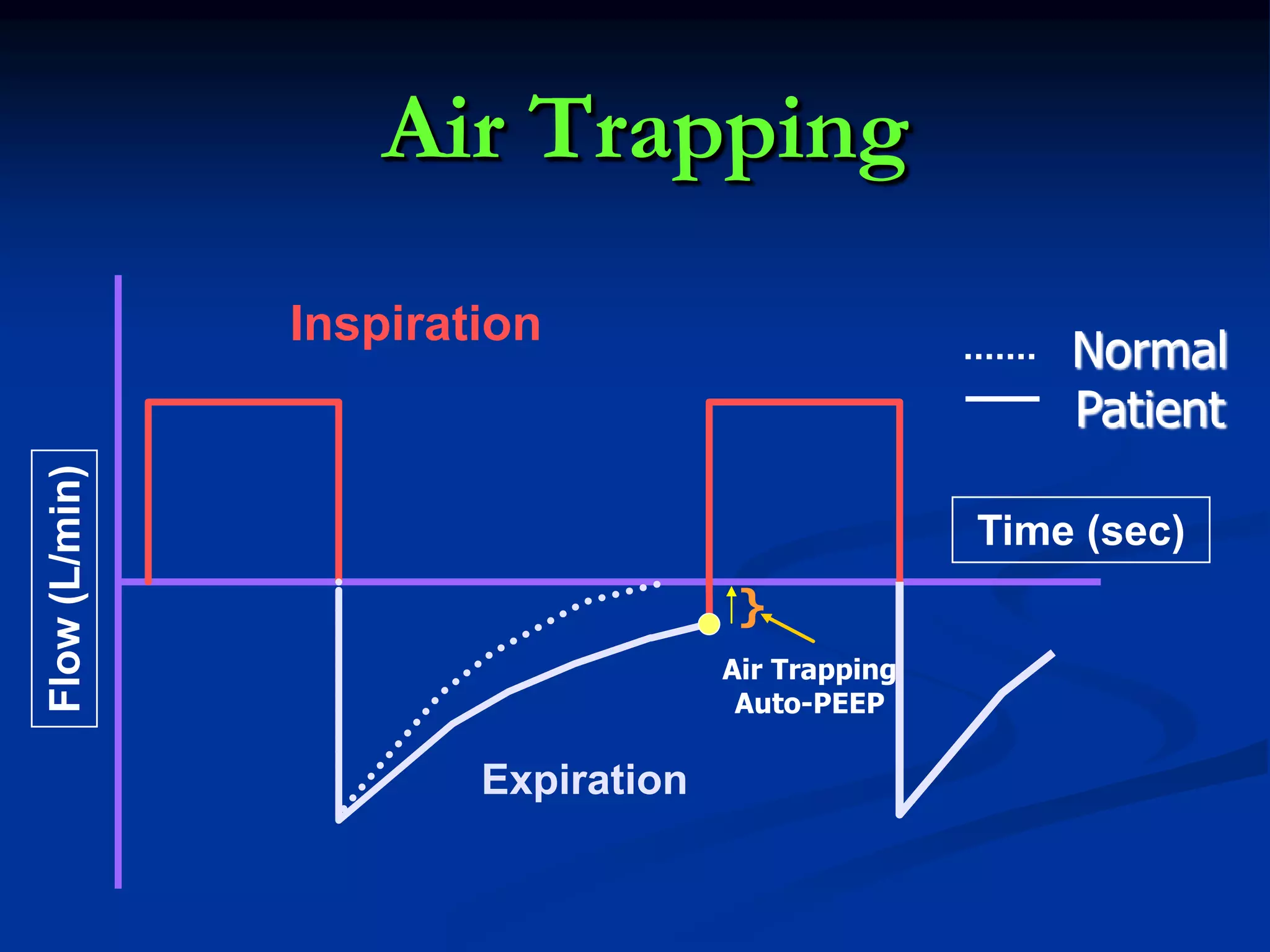 Air Trapping
Inspiration
Expiration
Normal
Patient
Time (sec)
Flow(L/min)
Air Trapping
Auto-PEEP
}
 