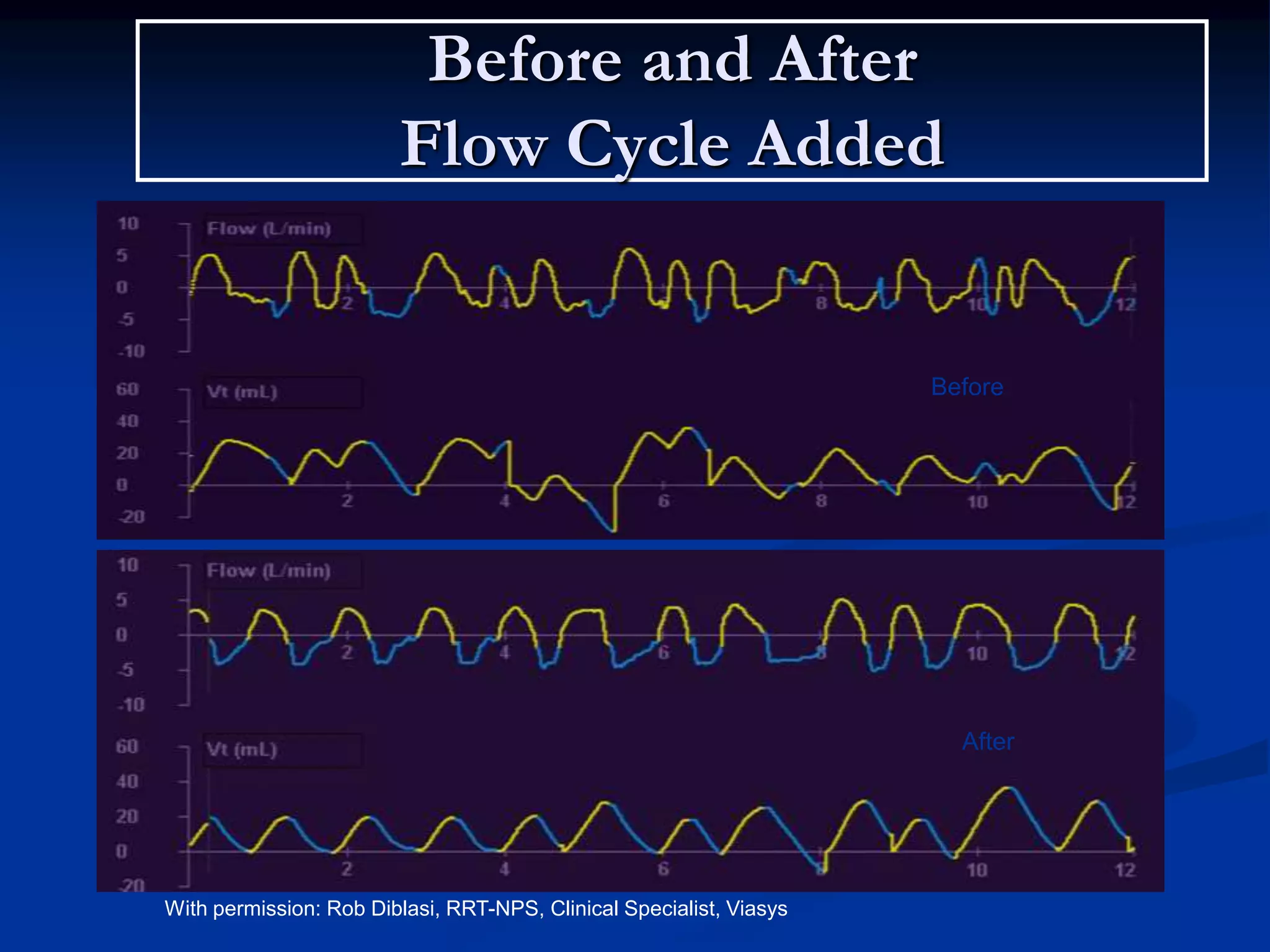 Before and After
Flow Cycle Added
With permission: Rob Diblasi, RRT-NPS, Clinical Specialist, Viasys
Before
After
 